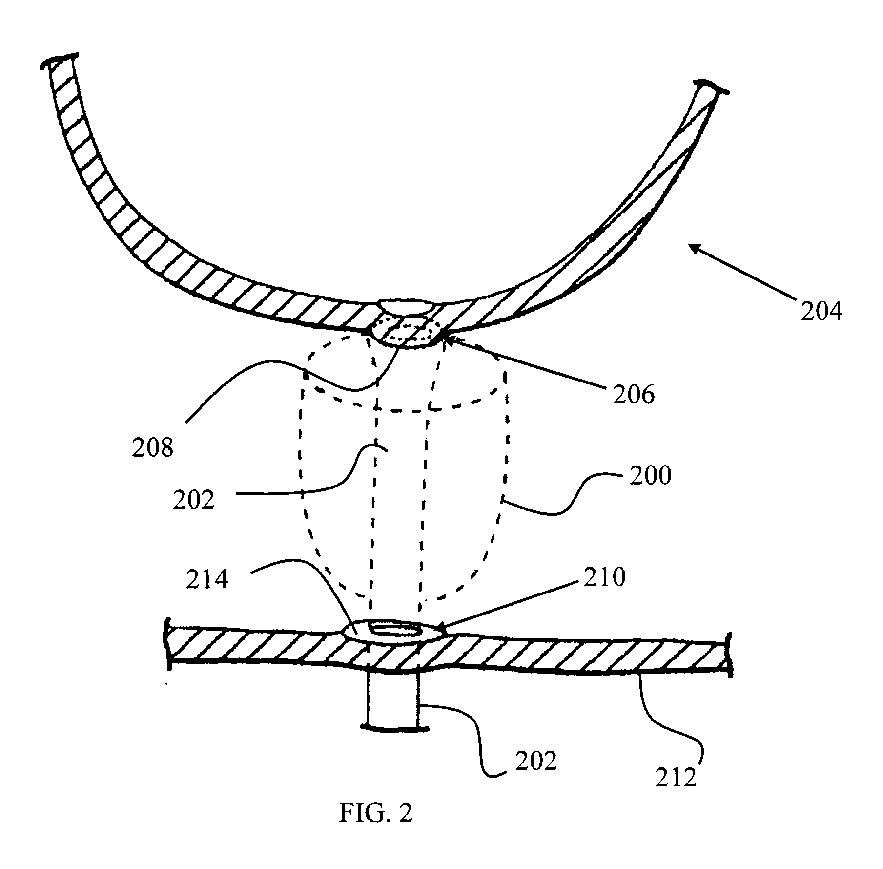 Anastomosis device and related methods