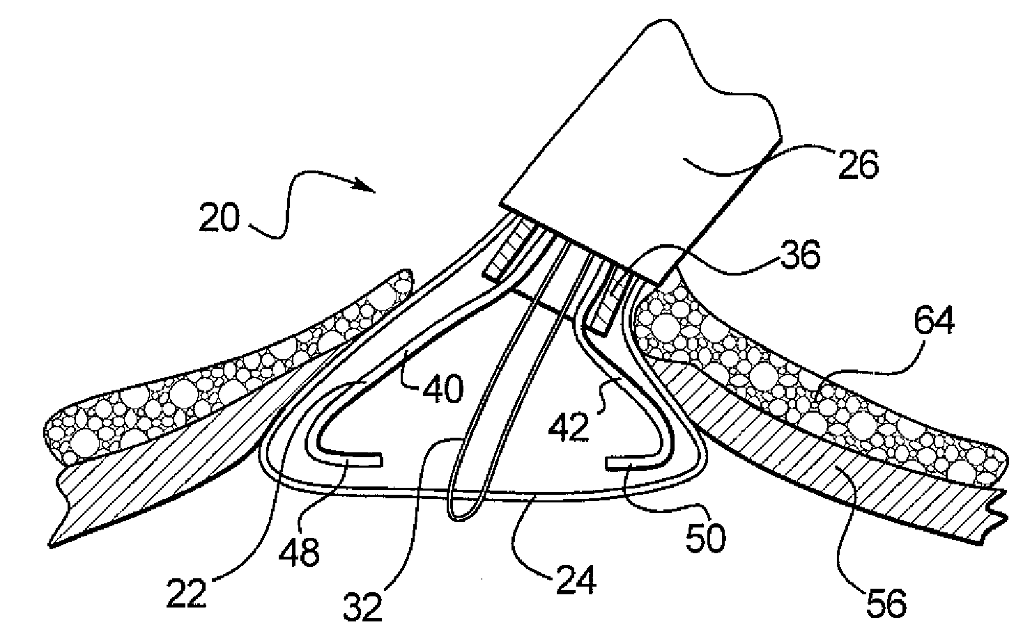 Connective Tissue Closure Device and Method