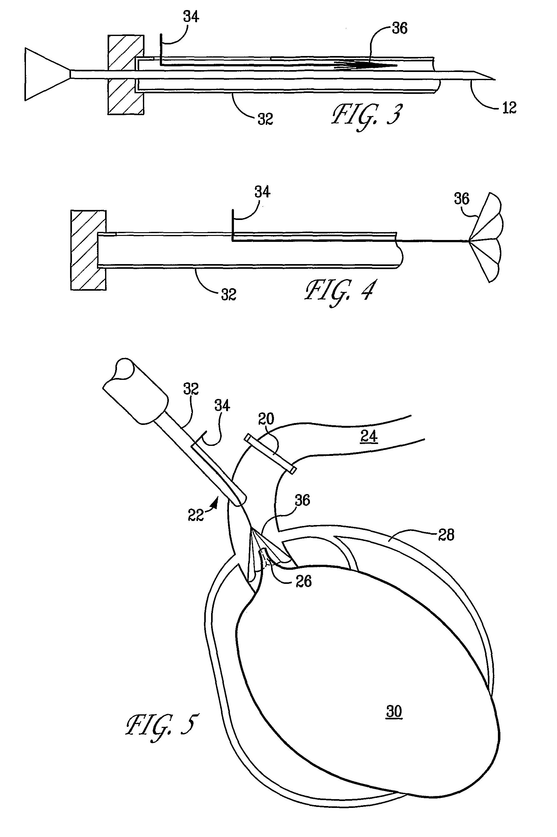 Device for facilitating cardioplegia delivery in patients with aortic insufficiency