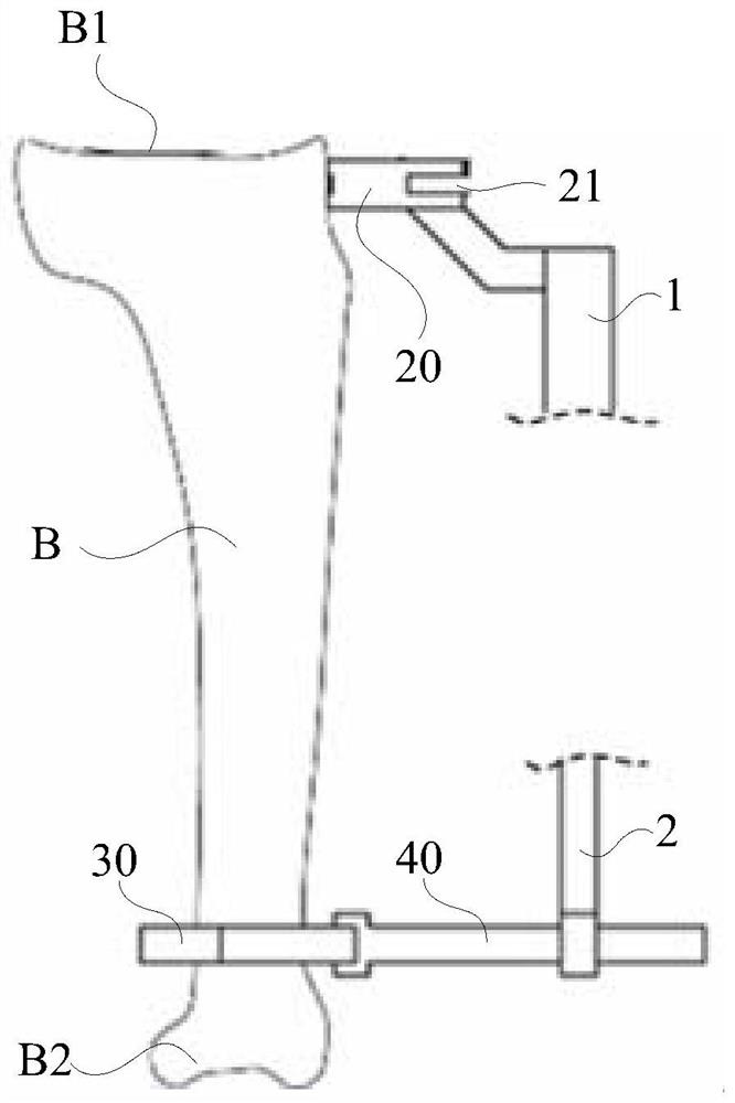 Tibia osteotomy system and osteotomy quantity adjusting device thereof