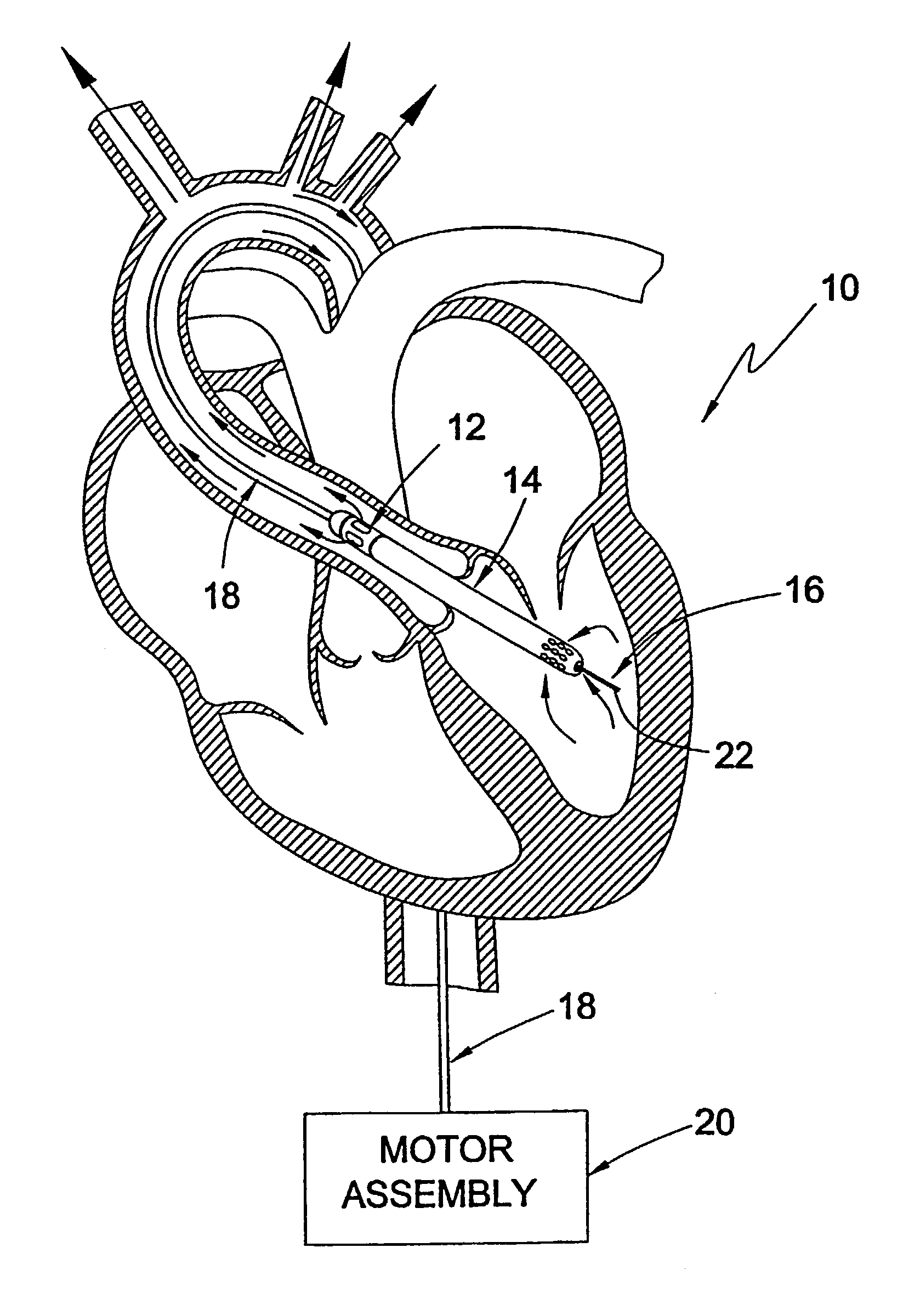 Guidable intravascular blood pump and related methods
