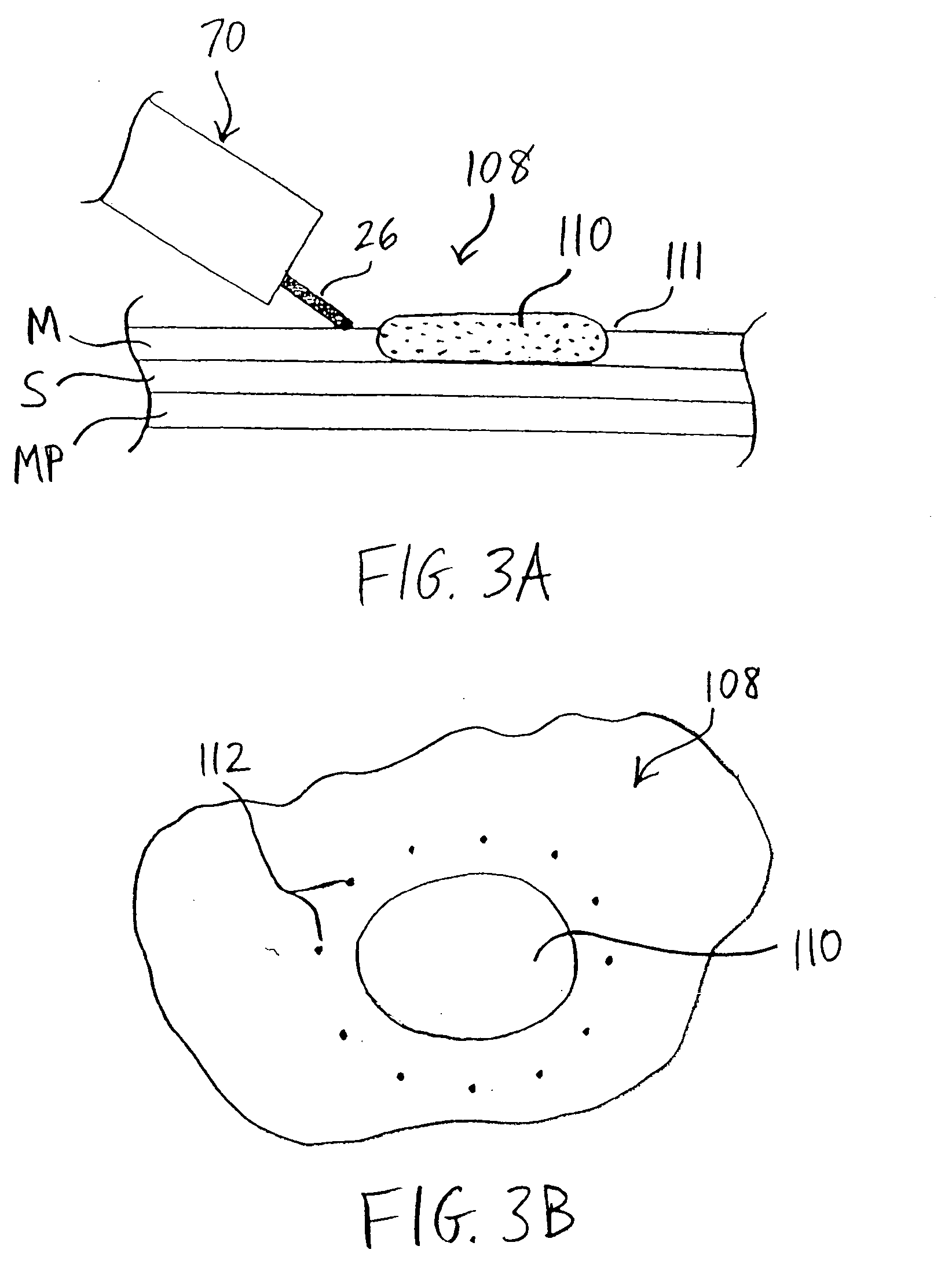 Apparatus and methods for endoscopic resection of tissue