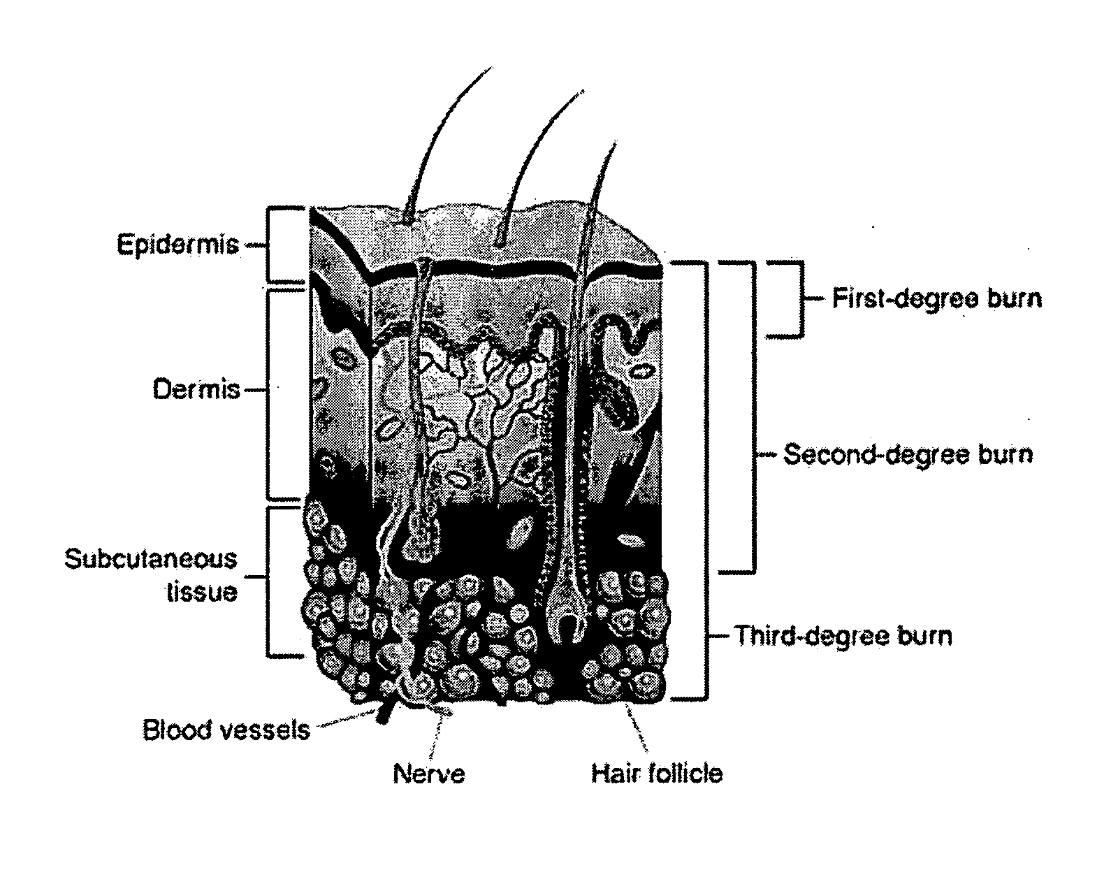 Compositions and methods for treating burns