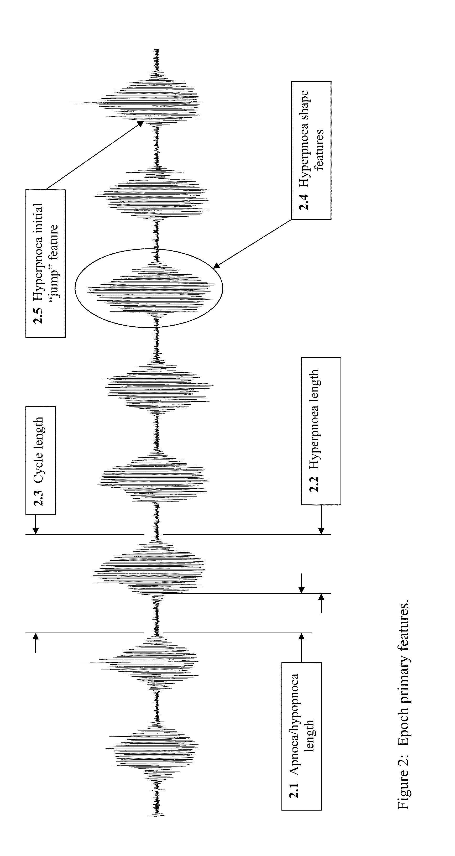 Method for detecting and discriminating breathing patterns from respiratory signals