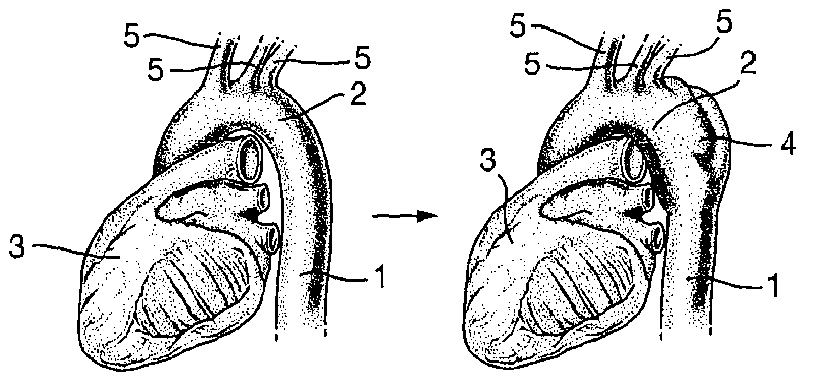 Curved stent graft assembly