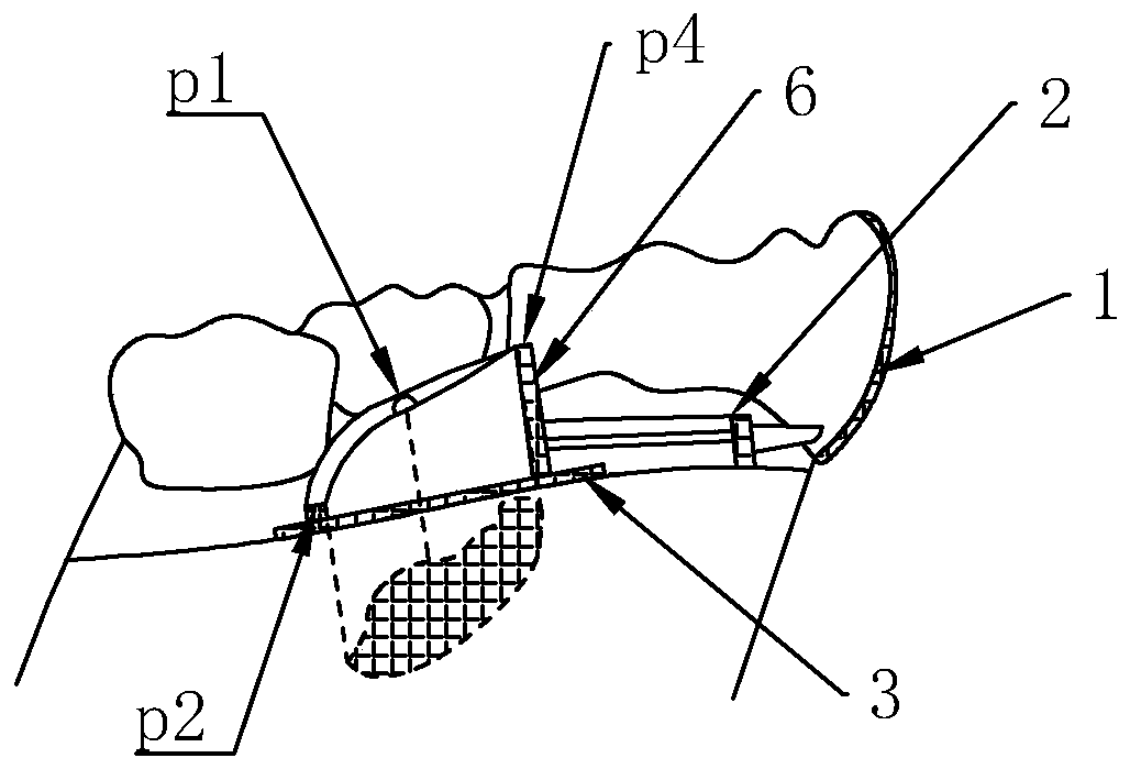 Positioning guide plate for removing unerupted supernumerary teeth in anterior tooth area, and manufacturing method thereof