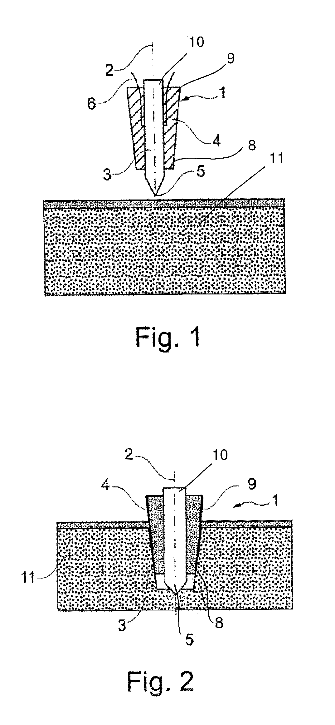 Fixation Device With Magnesium Core