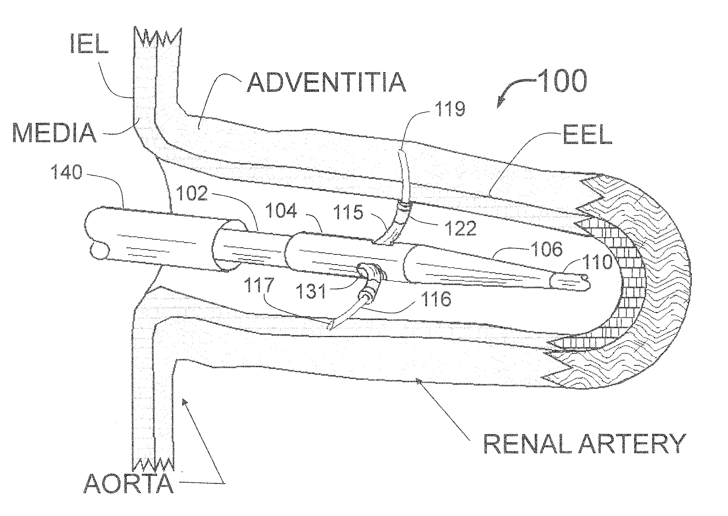 Peri-vascular tissue ablation catheter with unique injection fitting