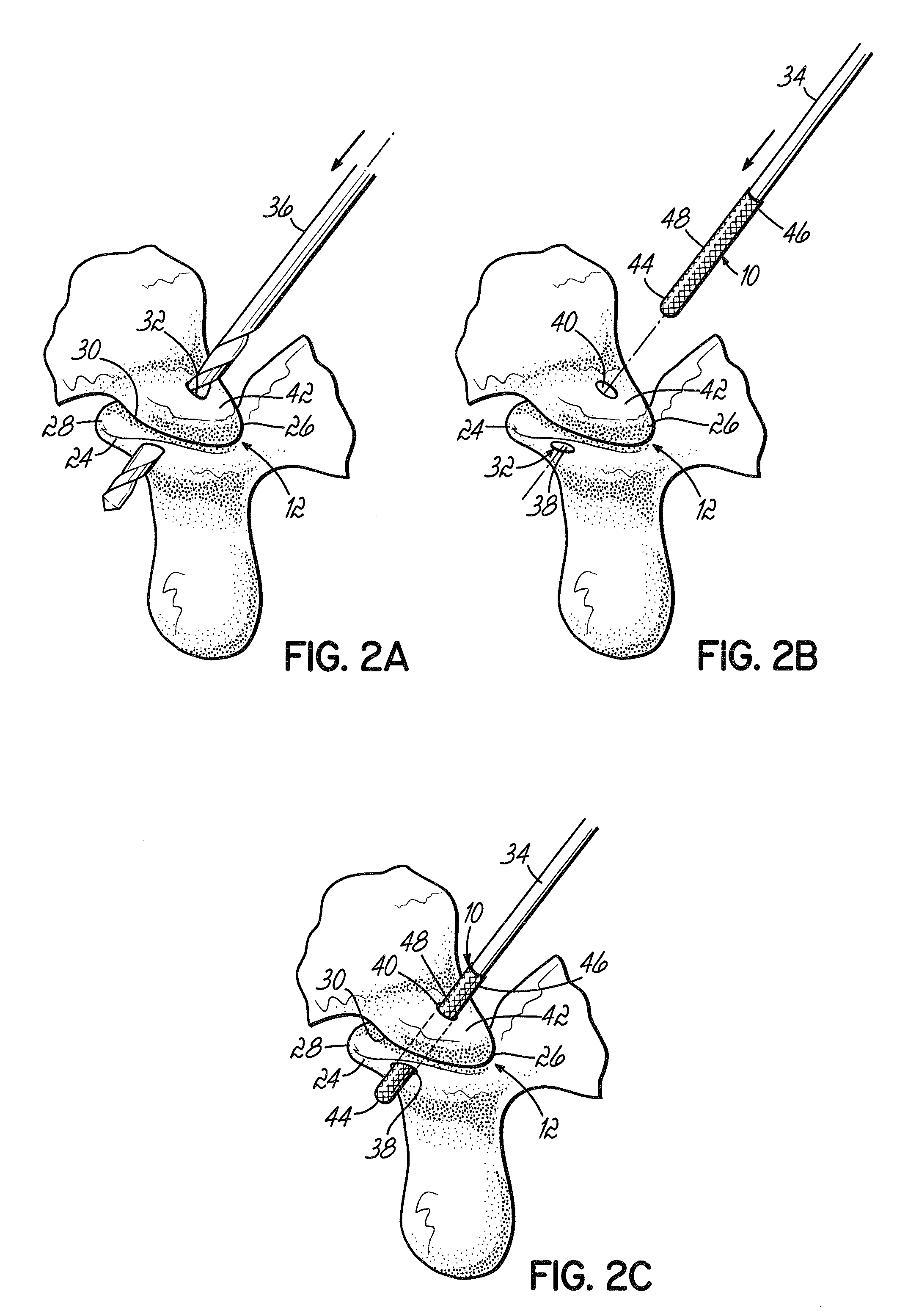 Method for stabilizing a facet joint