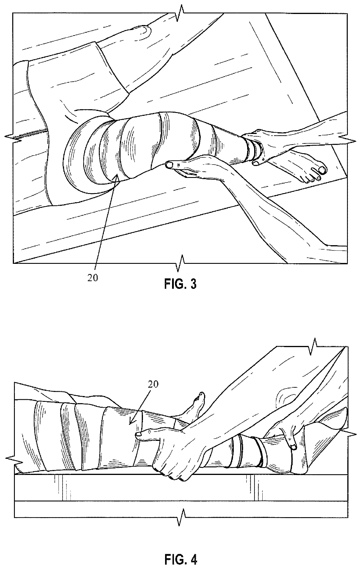 Method for producing a negative cast for a brace with corrective forces to control PLC deficiencies