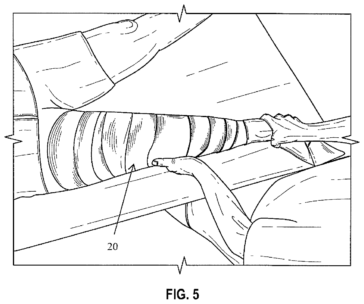 Method for producing a negative cast for a brace with corrective forces to control PLC deficiencies