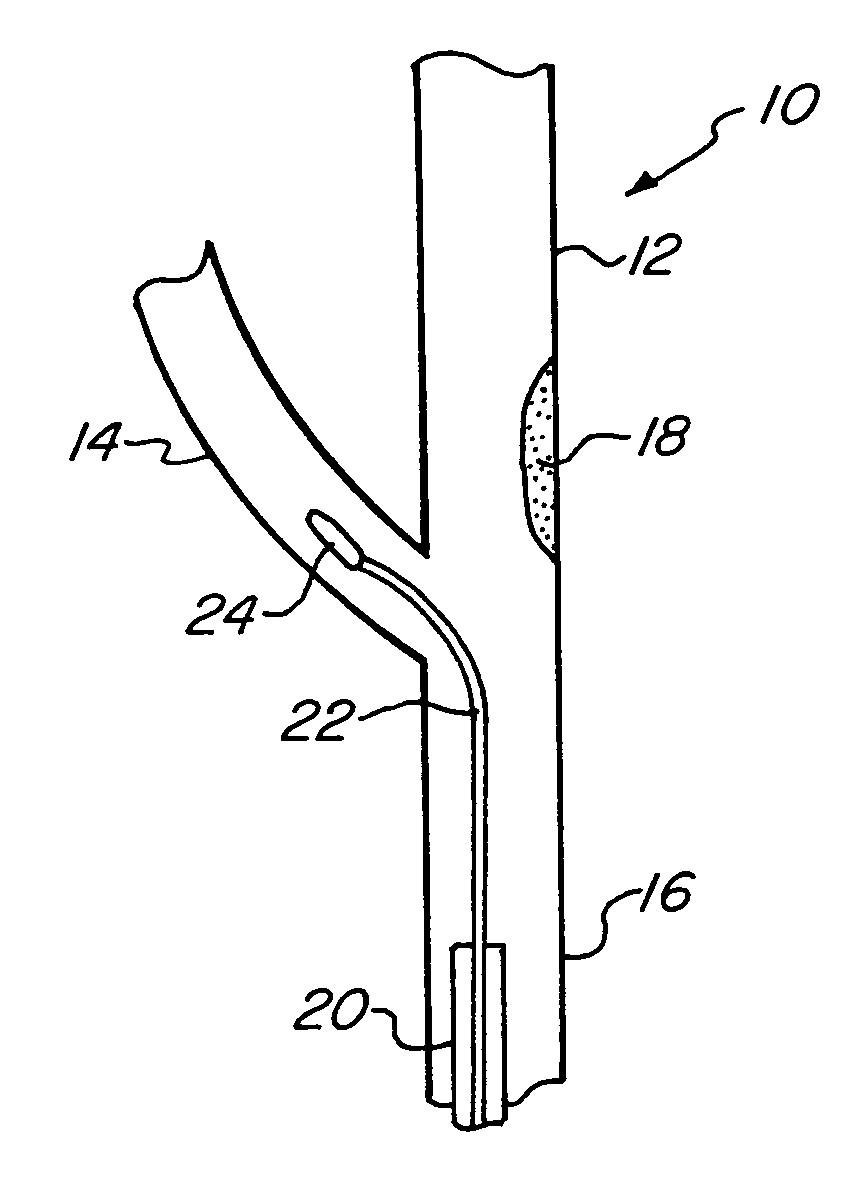 Proximal protection balloon catheter method and device