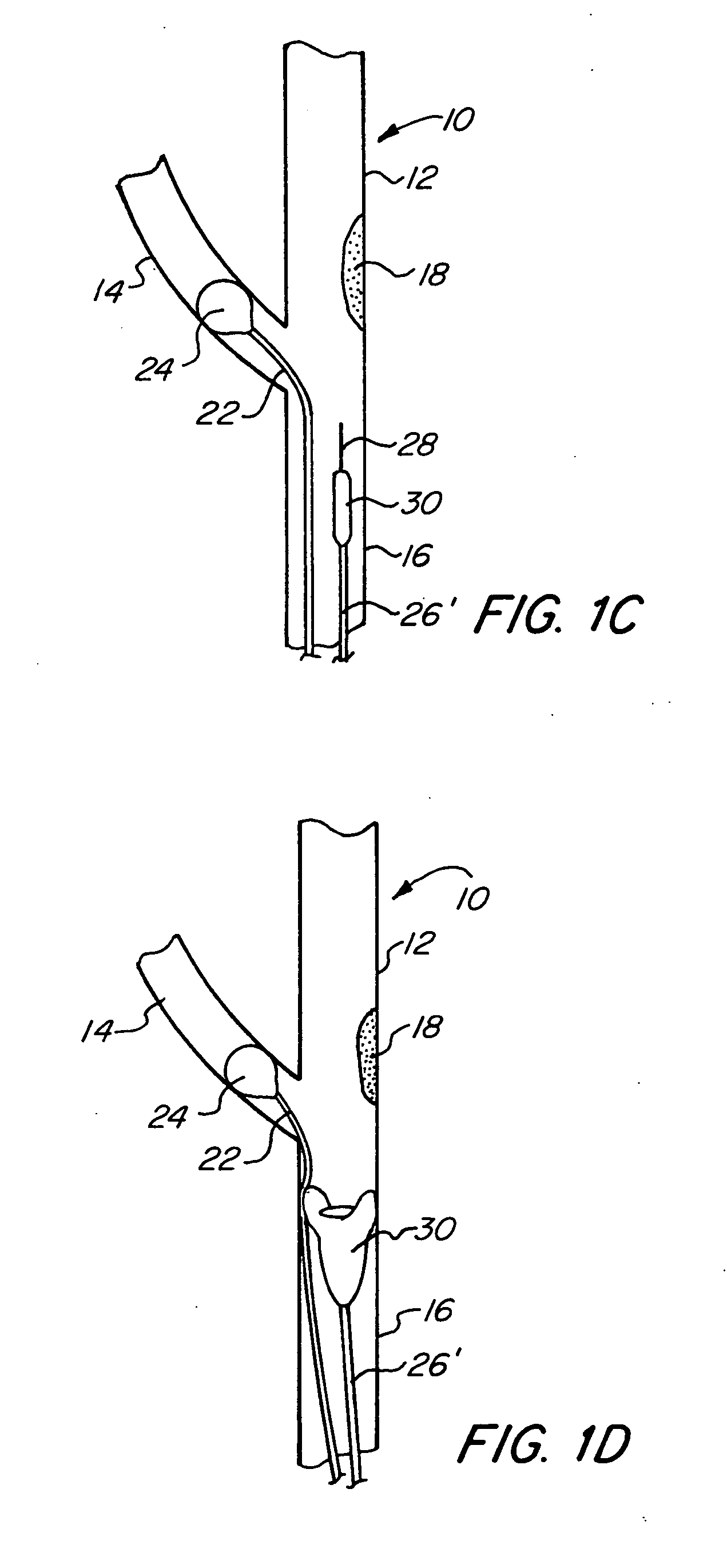 Proximal protection balloon catheter method and device