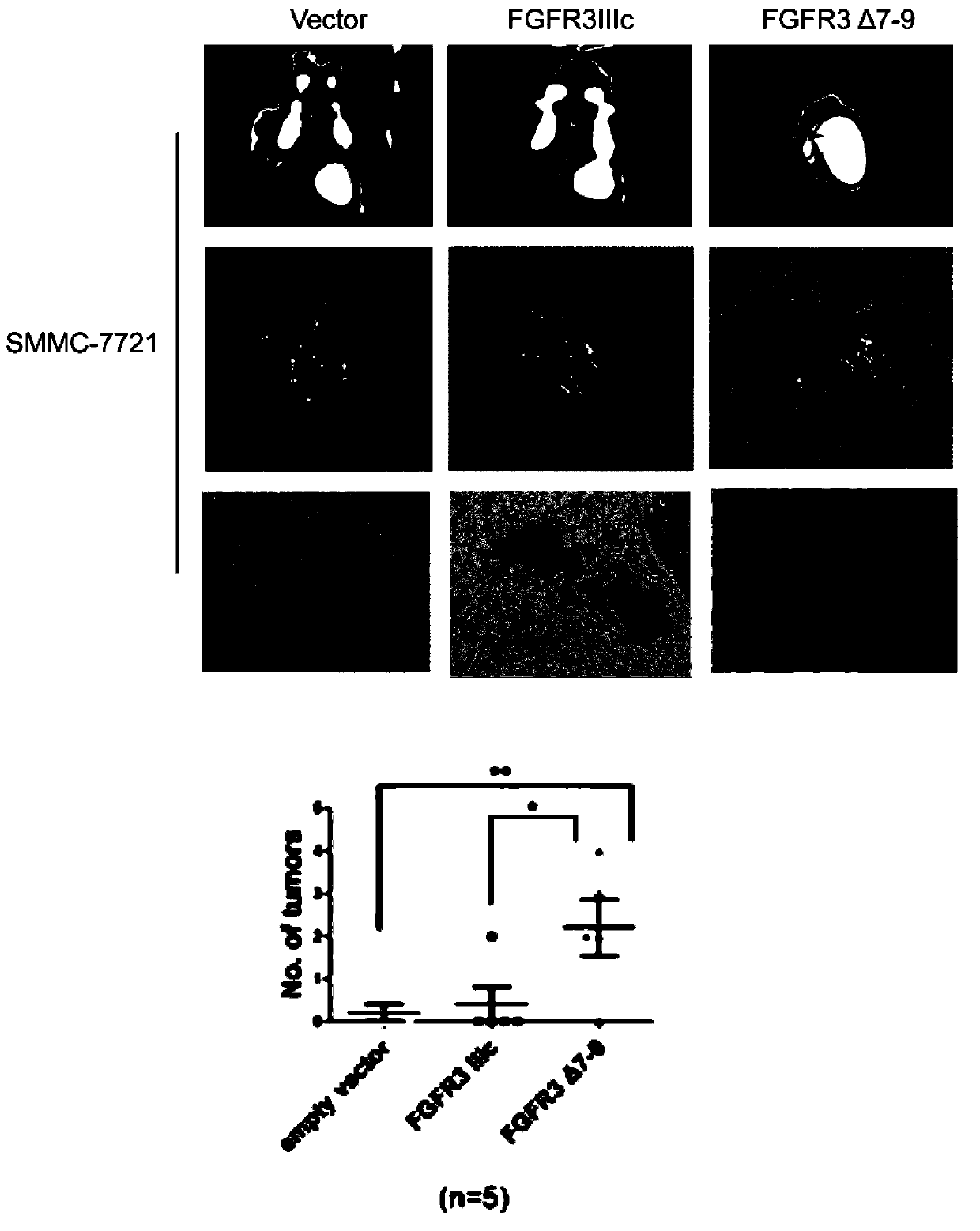 Novel splice variant of FGFR3 (Fibroblast Growth Factor Receptor 3) in liver carcinoma tissue and application thereof