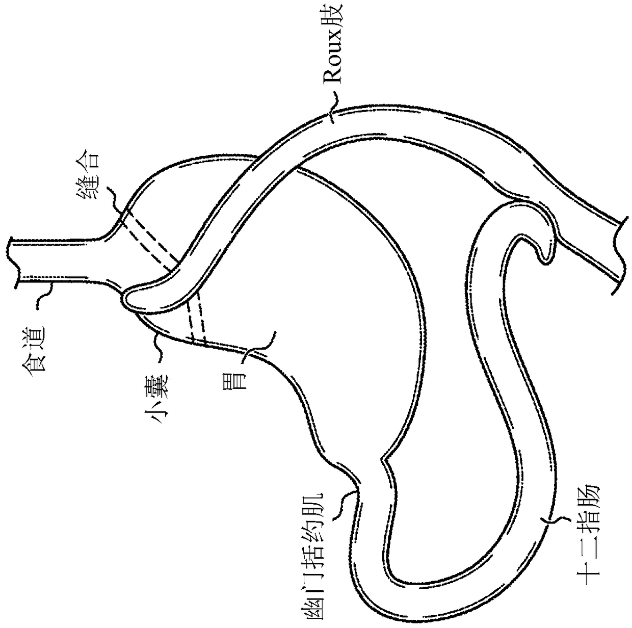 Medical device and method for preventing bile reflux following bariatric surgery