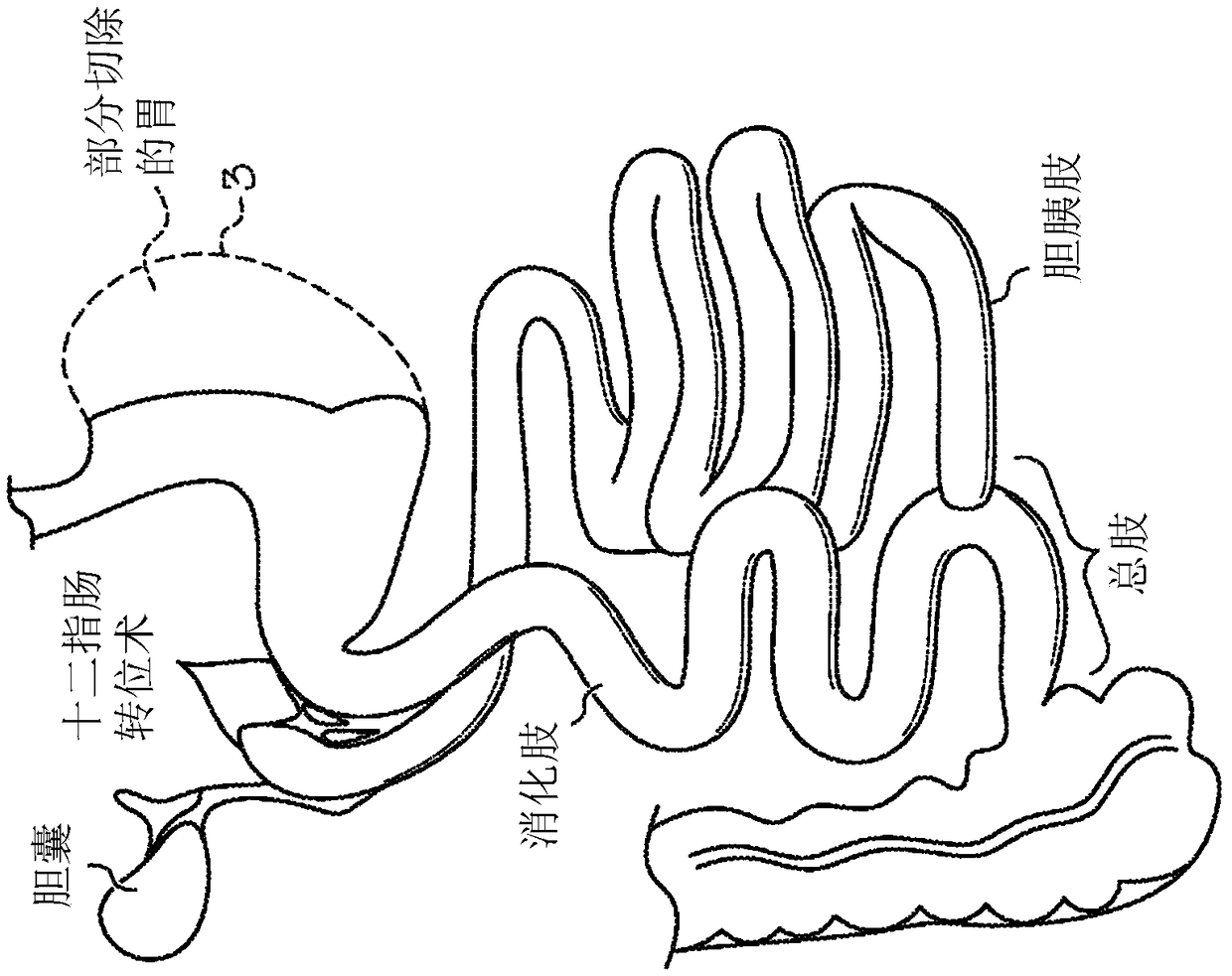 Medical device and method for preventing bile reflux following bariatric surgery