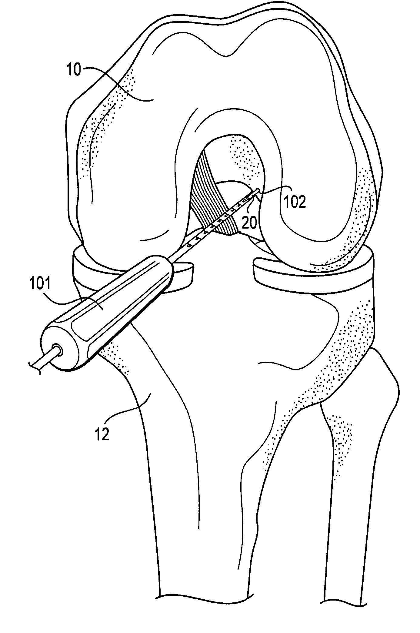 Method of ACL reconstruction using dual-sided rotary drill cutter