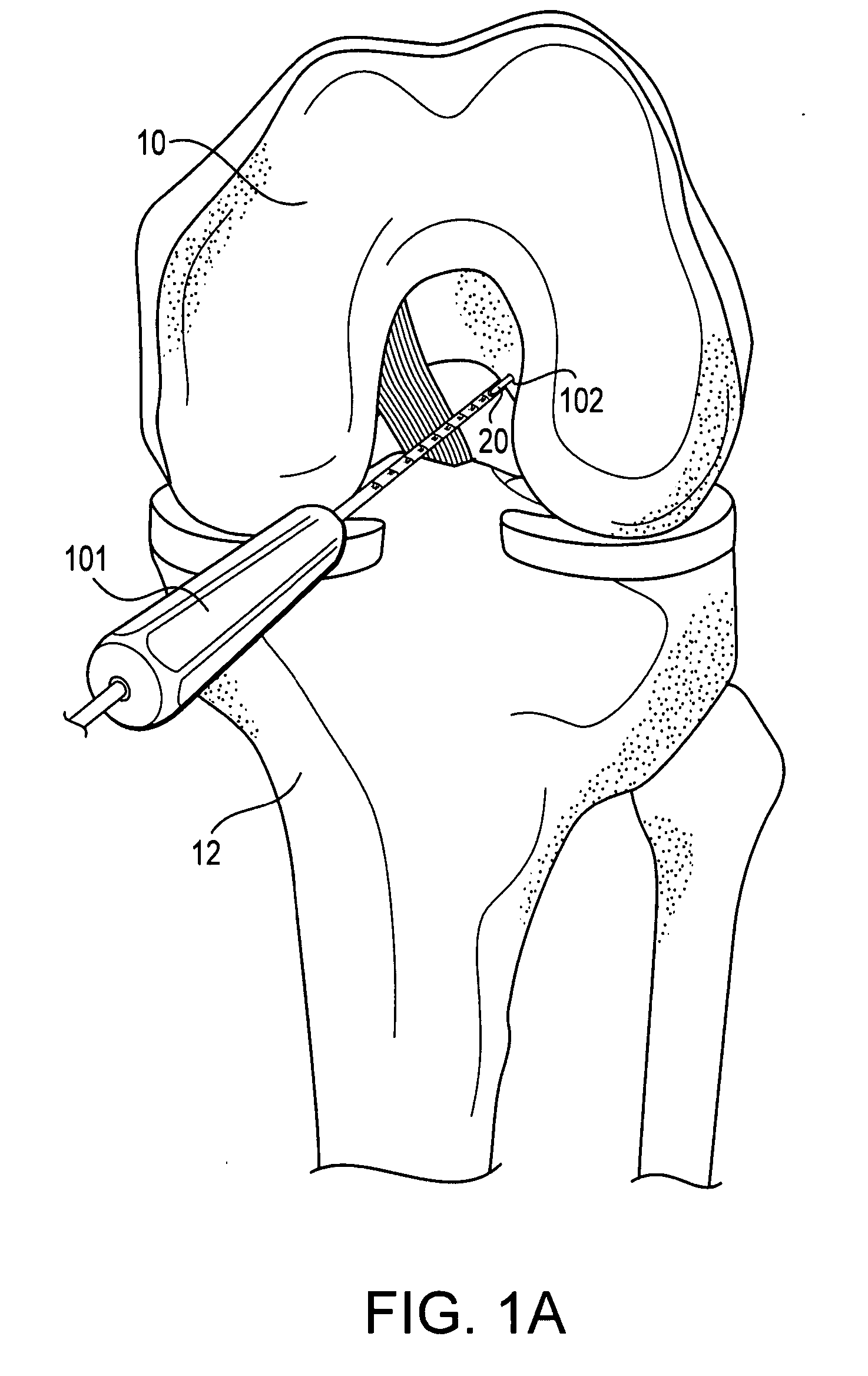 Method of ACL reconstruction using dual-sided rotary drill cutter