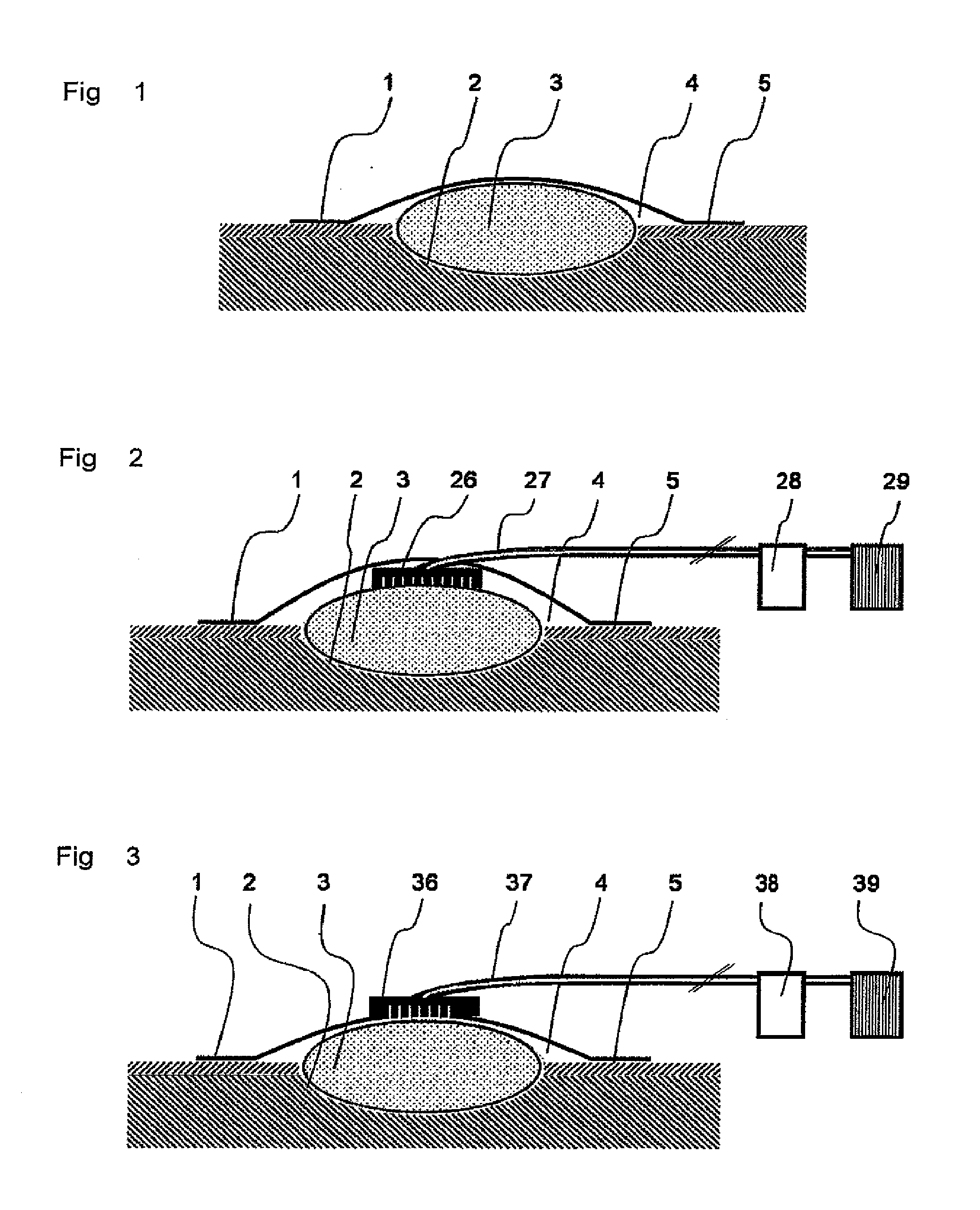Method for vacuum therapy of wounds