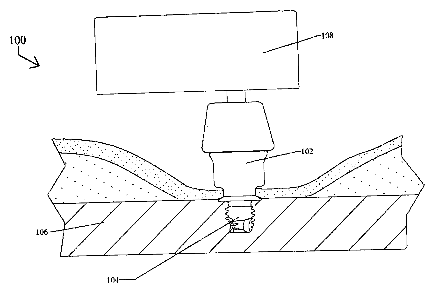 Hearing-aid anchoring element