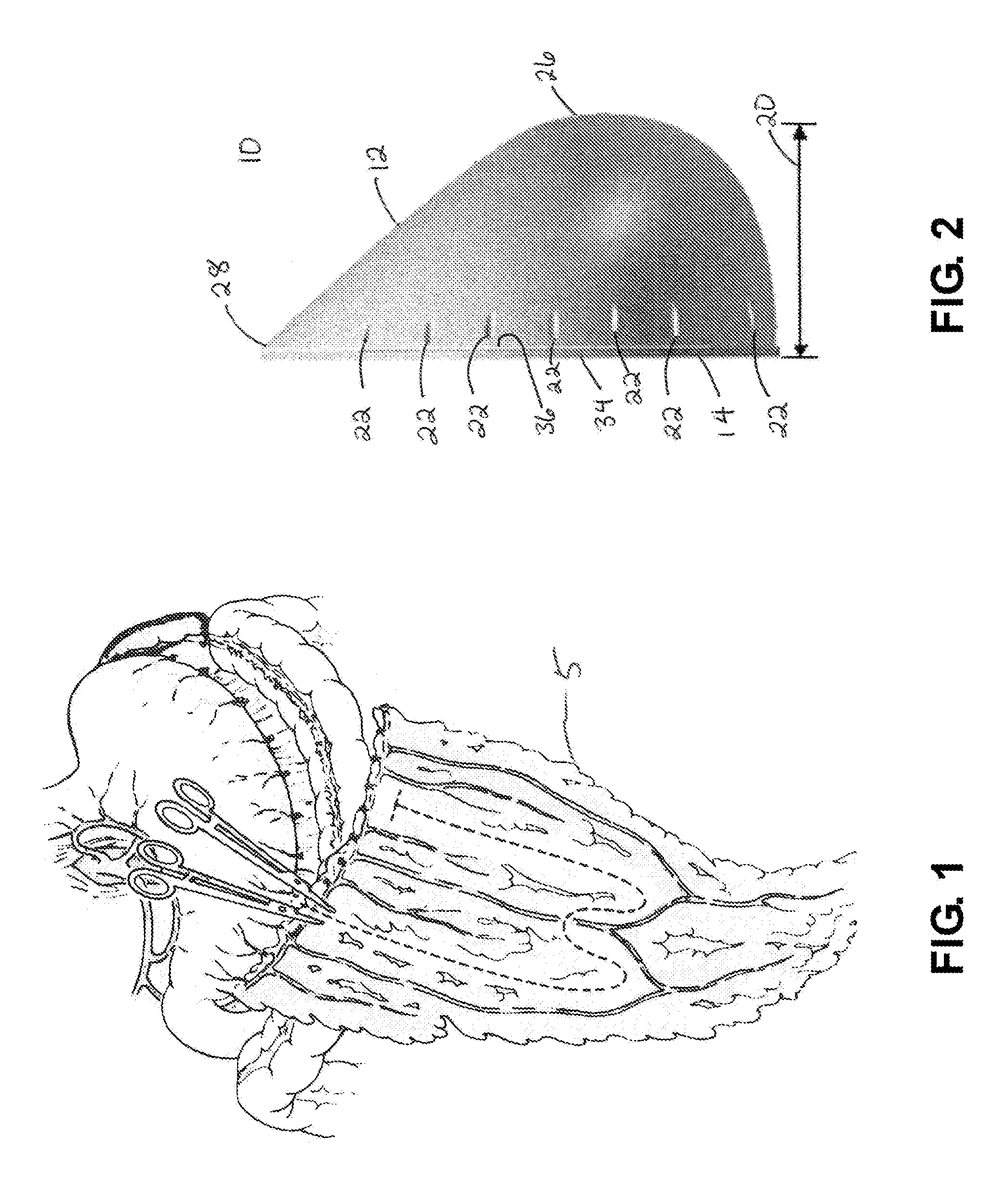 Breast Reconstruction Device And Methods