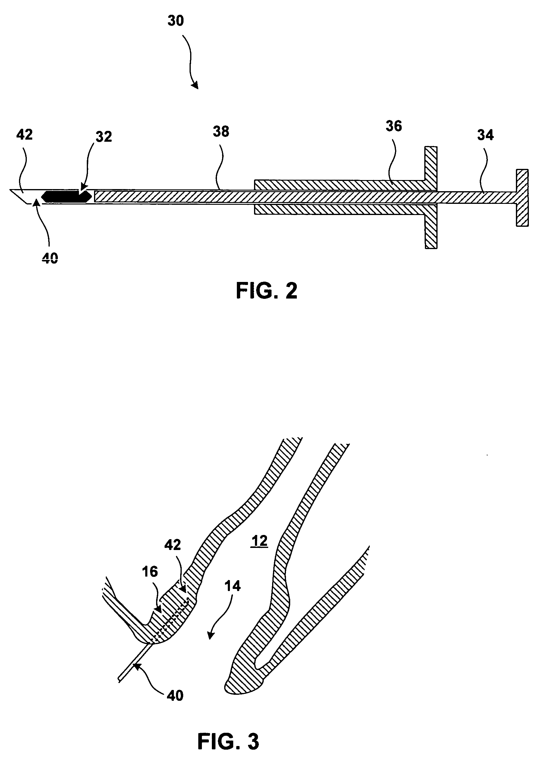 Implantable devices and methods for treating fecal incontinence