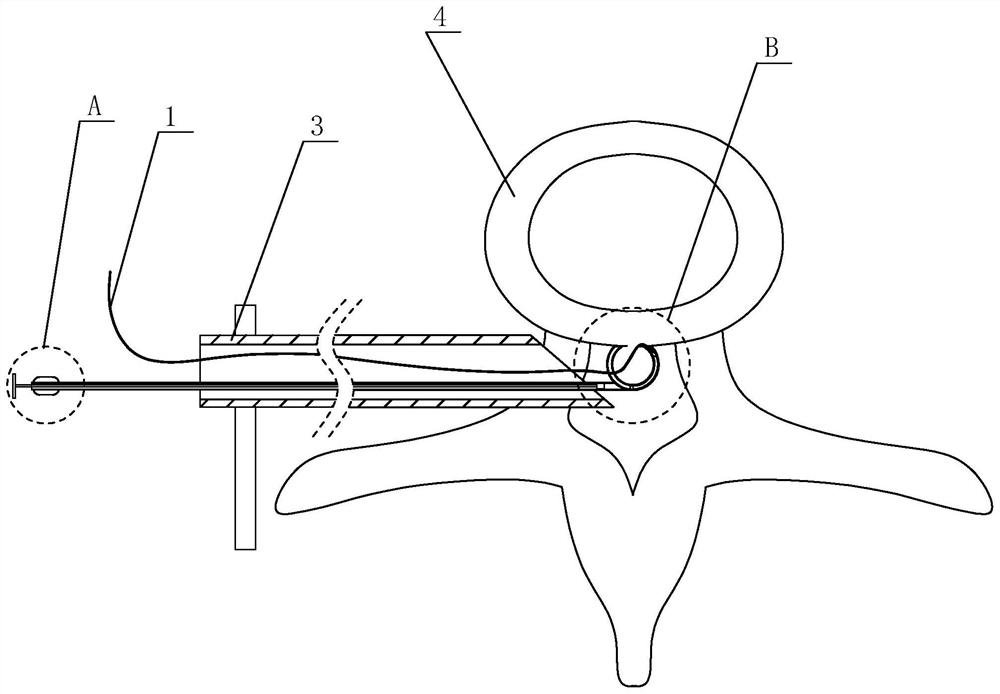 Single-needle positioning suture device for herniated intervertebral disc annulus fibrosus
