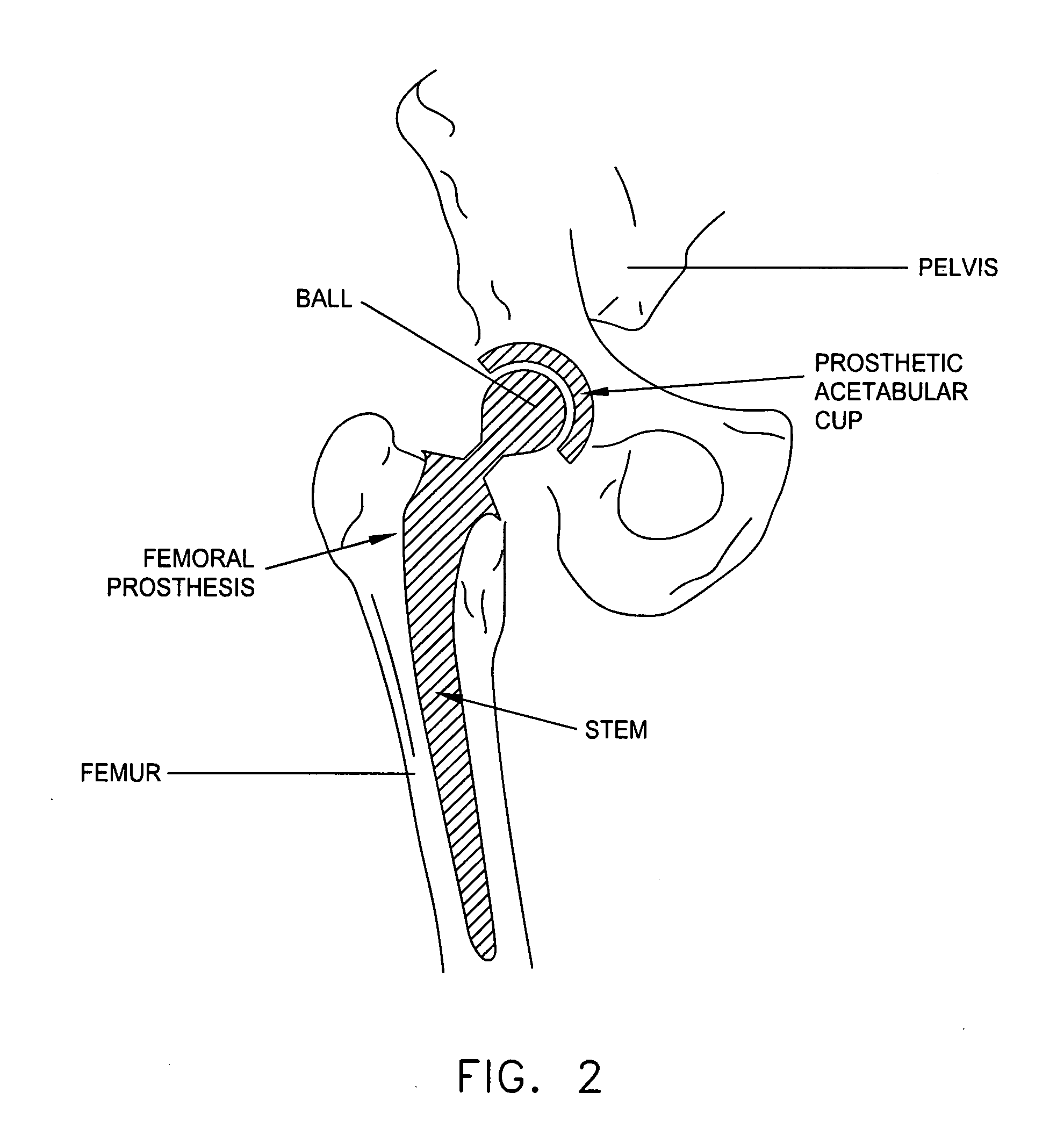 Computer-guided system for orienting the acetabular cup in the pelvis during total hip replacement surgery