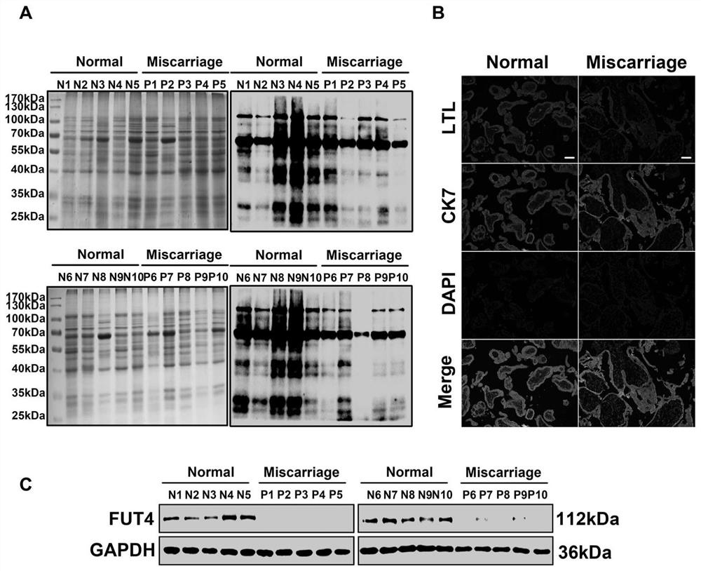 Biomarker for auxiliary diagnosis of recurrent abortion, and application thereof