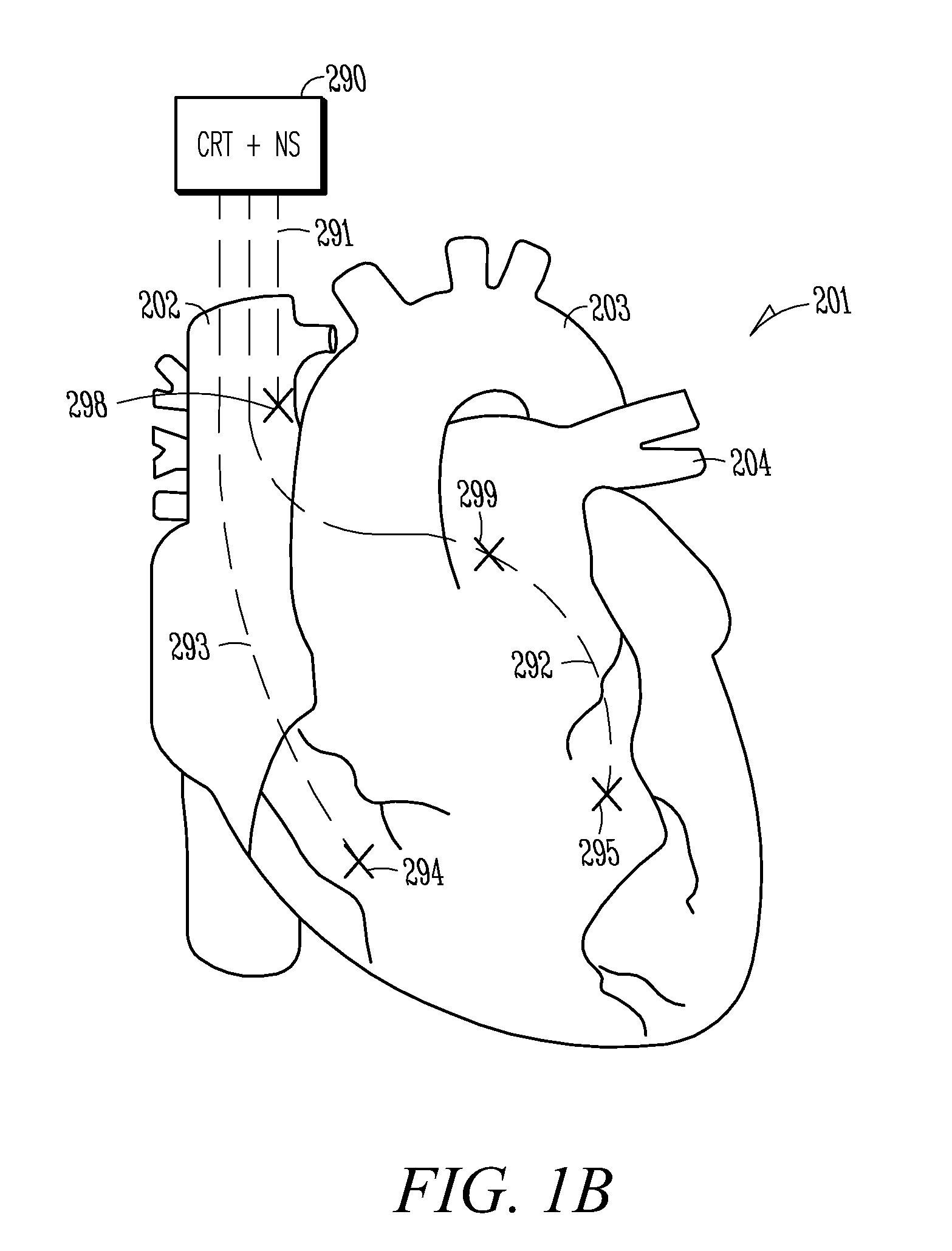 Transvascular neural stimulation device