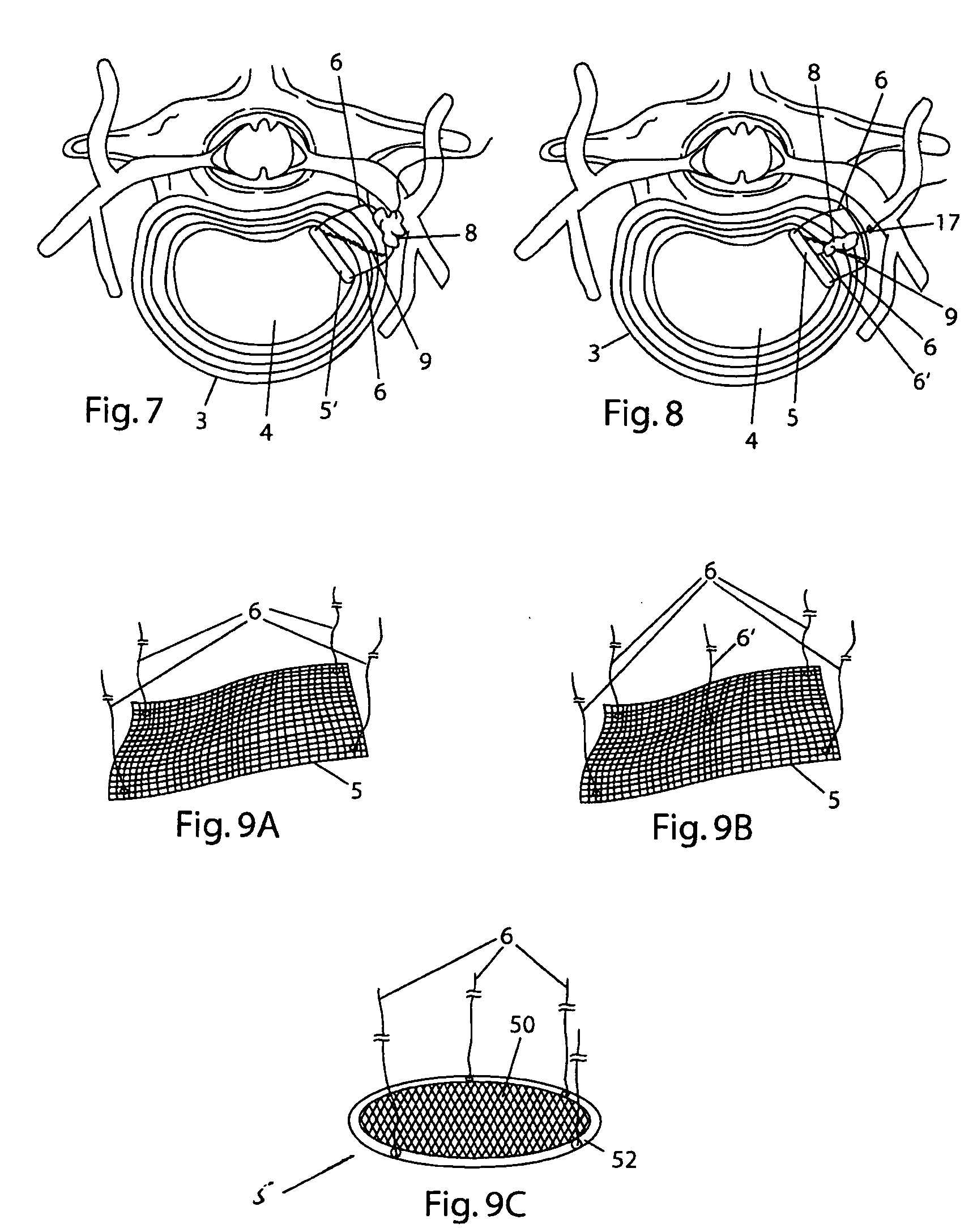 System and devices for the repair of a vertebral disc defect