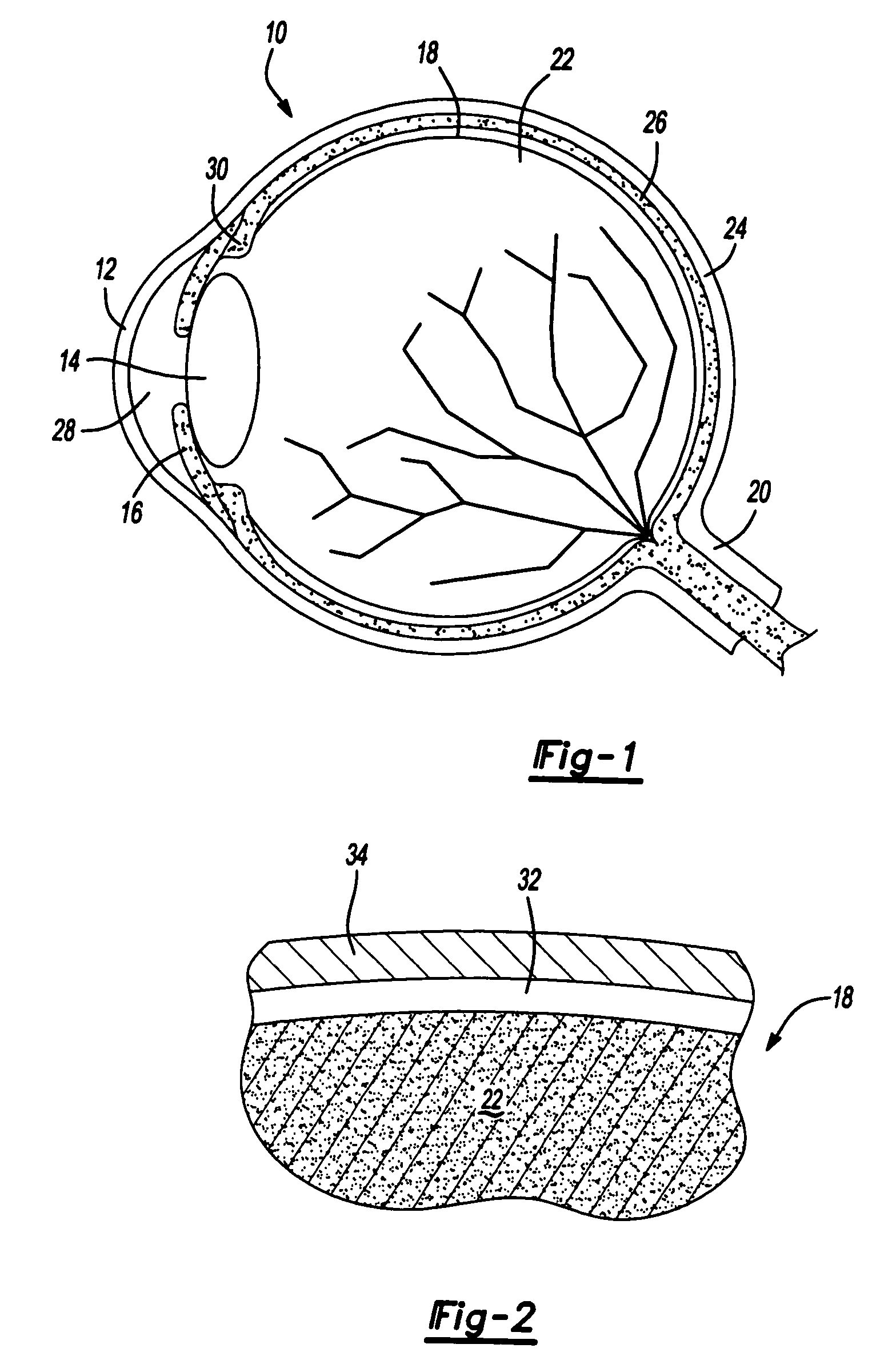 Ophthalmological surgery colorant and delivery system