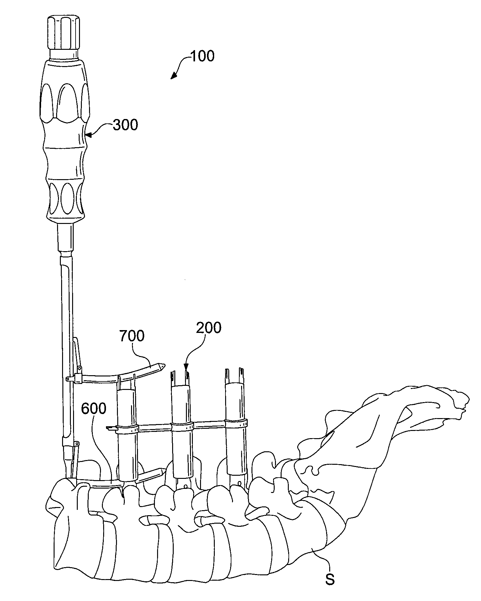 Percutaneous rod insertion system and method
