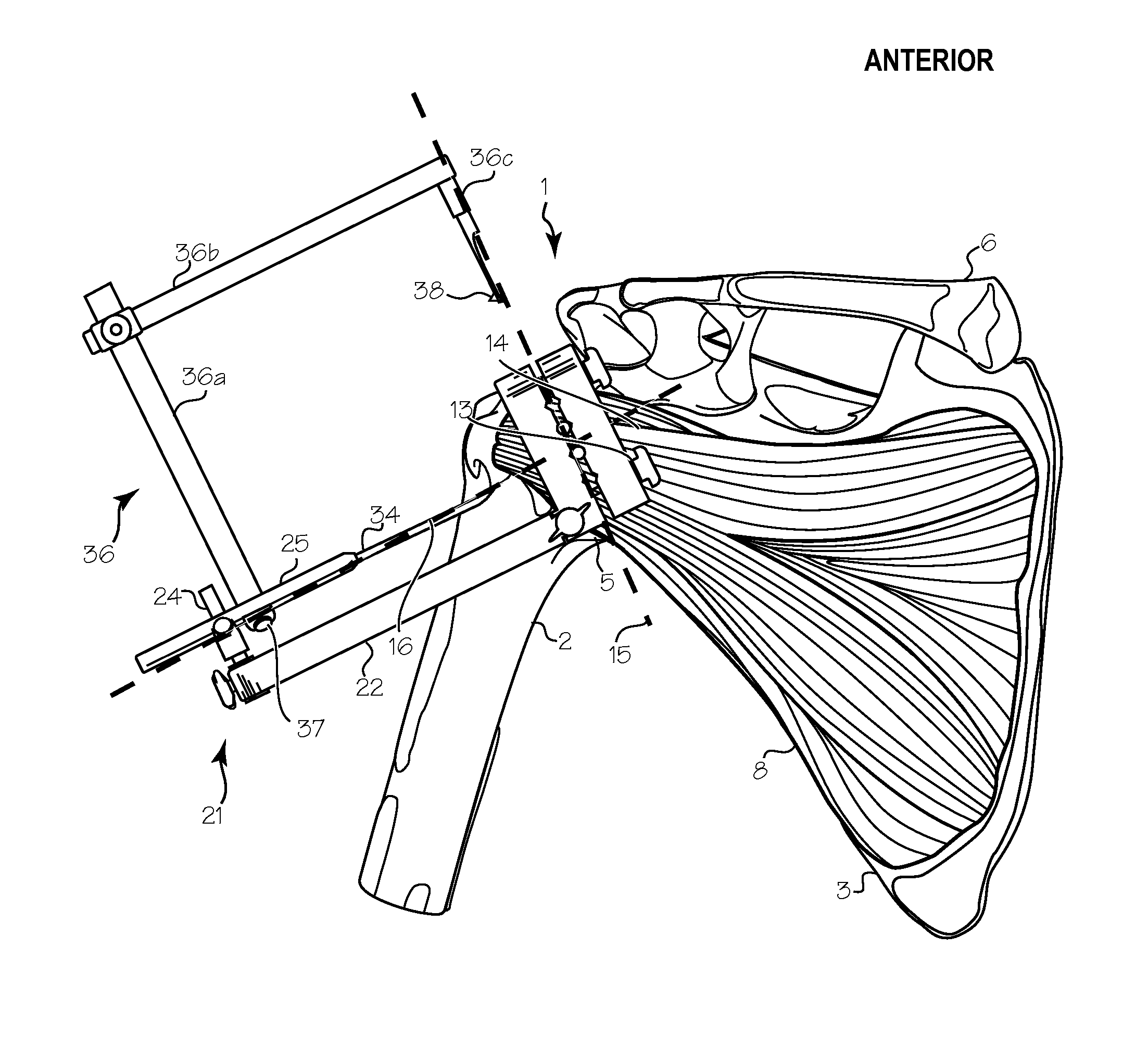 Method of humeral head resurfacing and/or replacement and system for accomplishing the method
