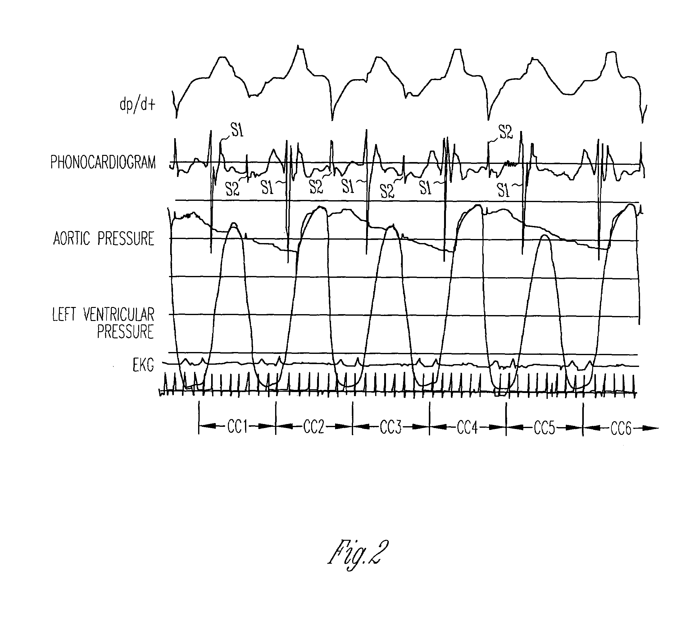 Method and apparatus for detecting acoustic oscillations in cardiac rhythm