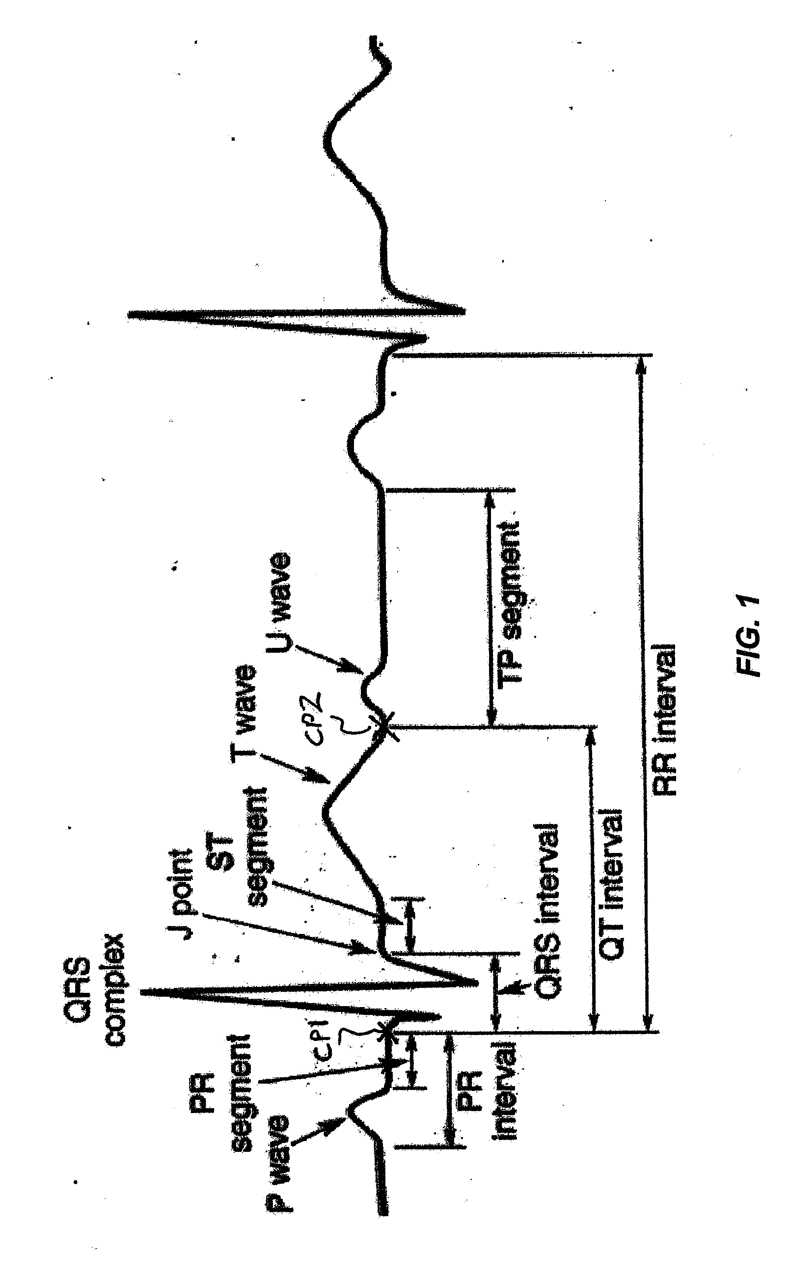 Method and apparatus for rapid interpretive analysis of electrocardiographic waveforms