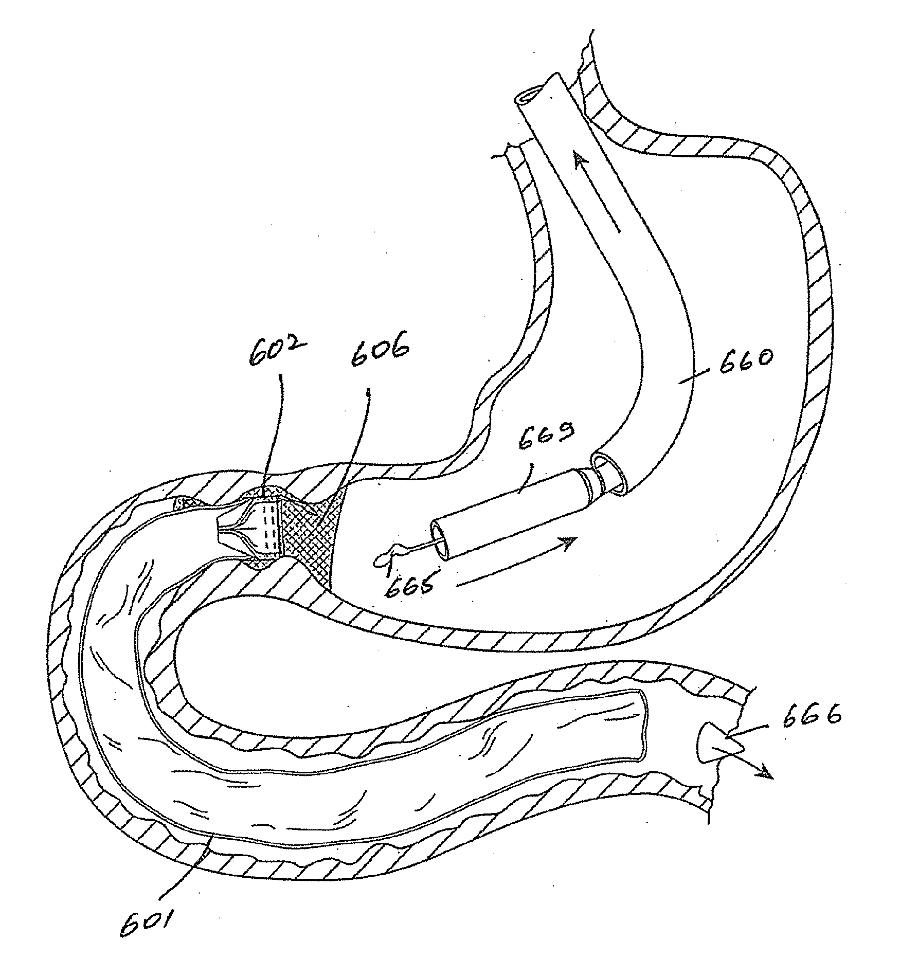 Luminal prosthesis and a gastrointestinal implant device
