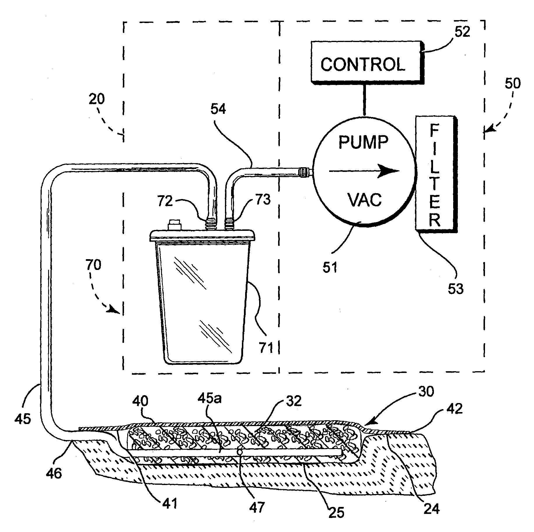 Reduced pressure treatment system