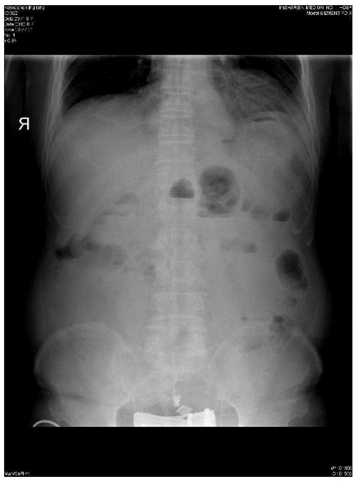 X-ray digestive tract image resolution evaluation method based on human anatomic structure