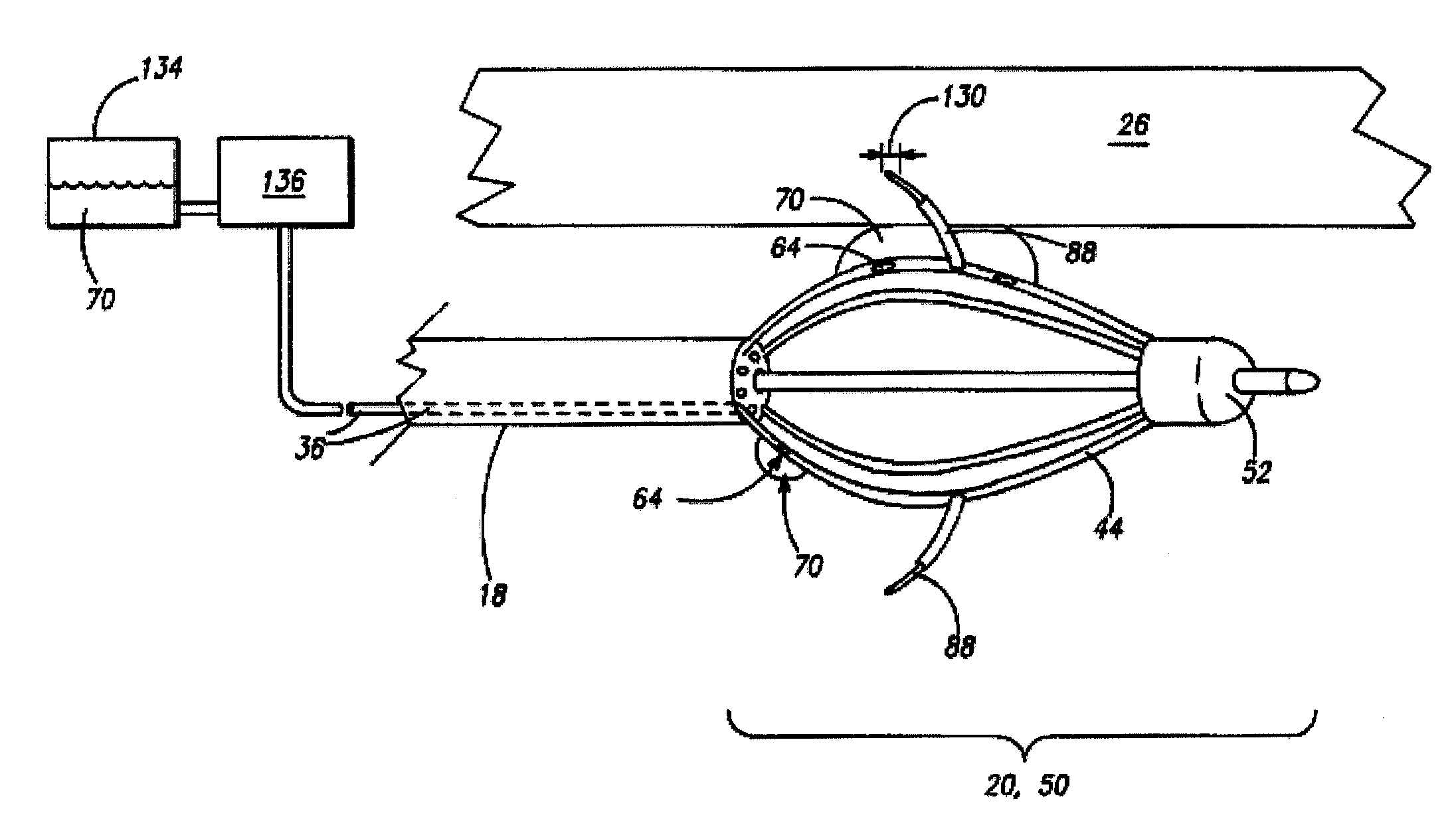 Methods and devices for treating urinary incontinence