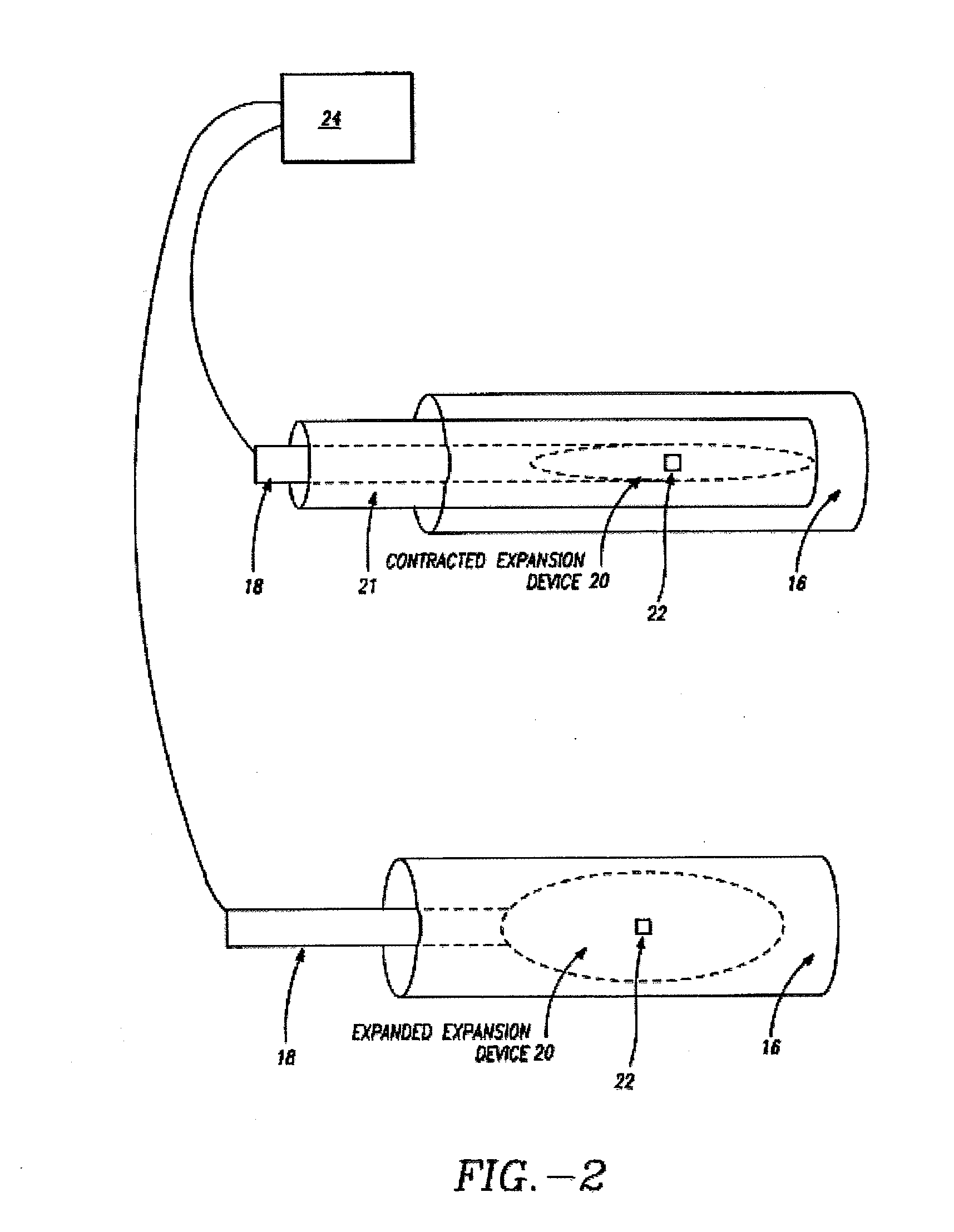 Methods and devices for treating urinary incontinence