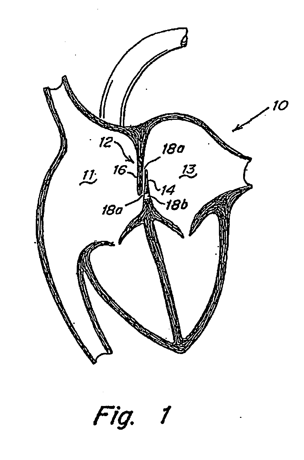 Adjustable length patent foramen ovale (PFO) occluder and catch system