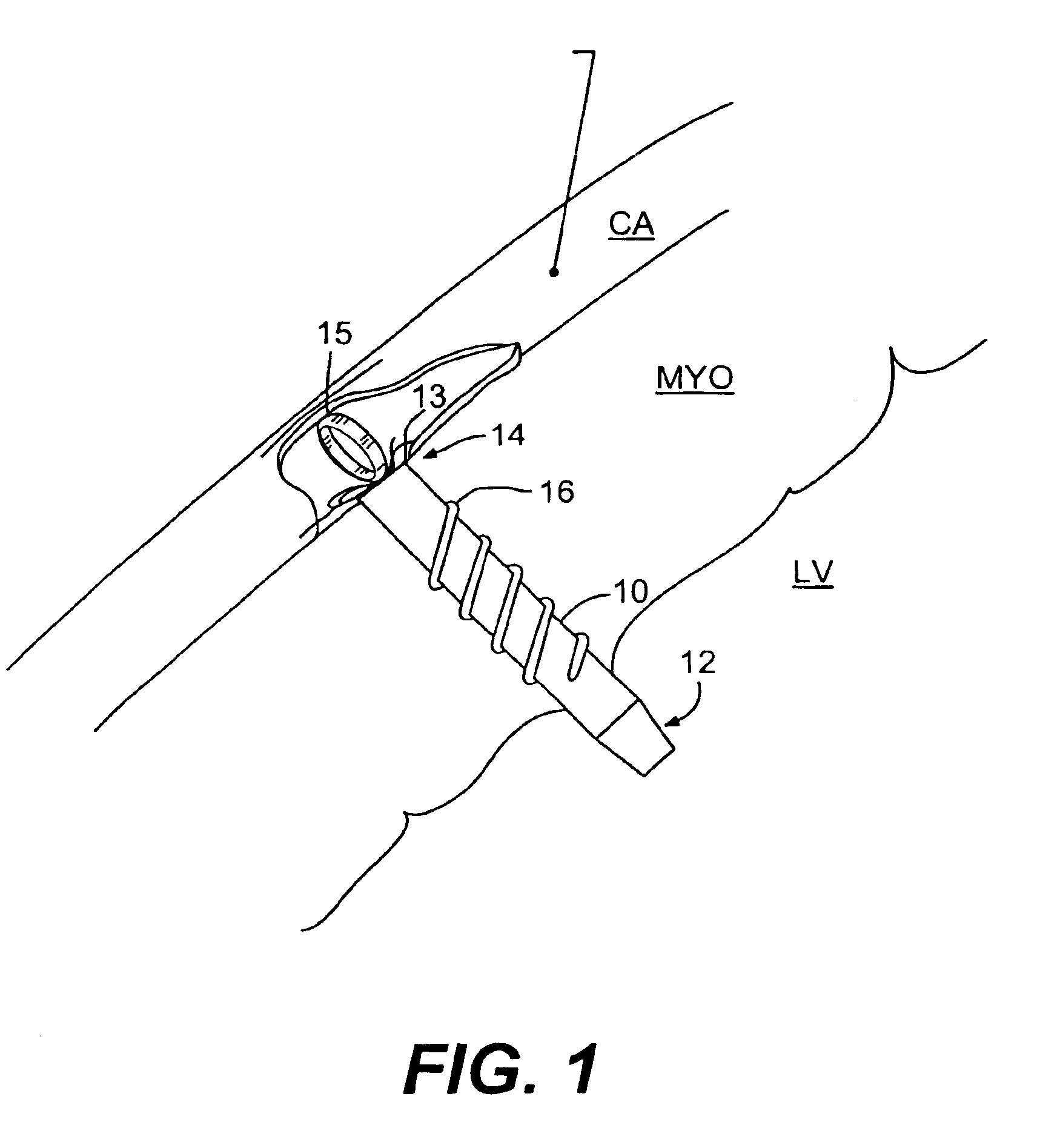 Left ventricular conduits and methods for delivery