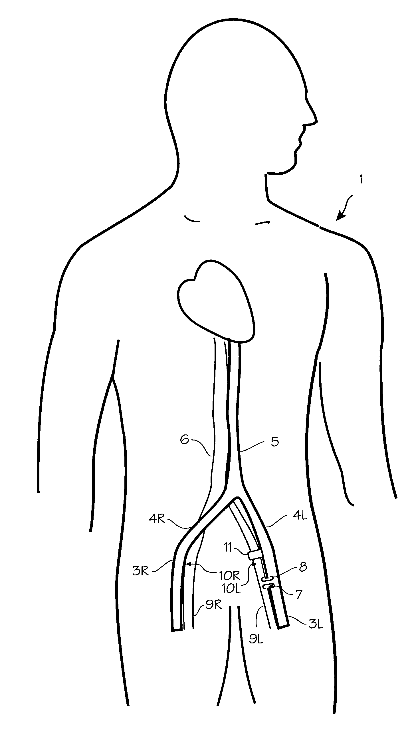 Method of treating COPD with artificial arterio-venous fistula and flow mediating systems