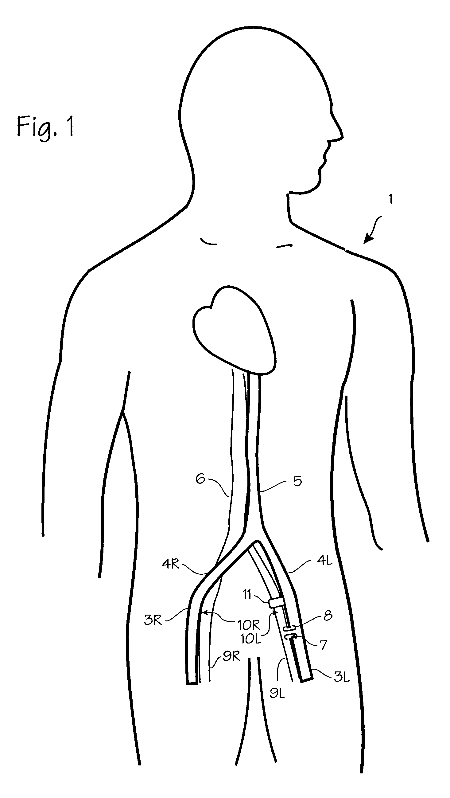 Method of treating COPD with artificial arterio-venous fistula and flow mediating systems