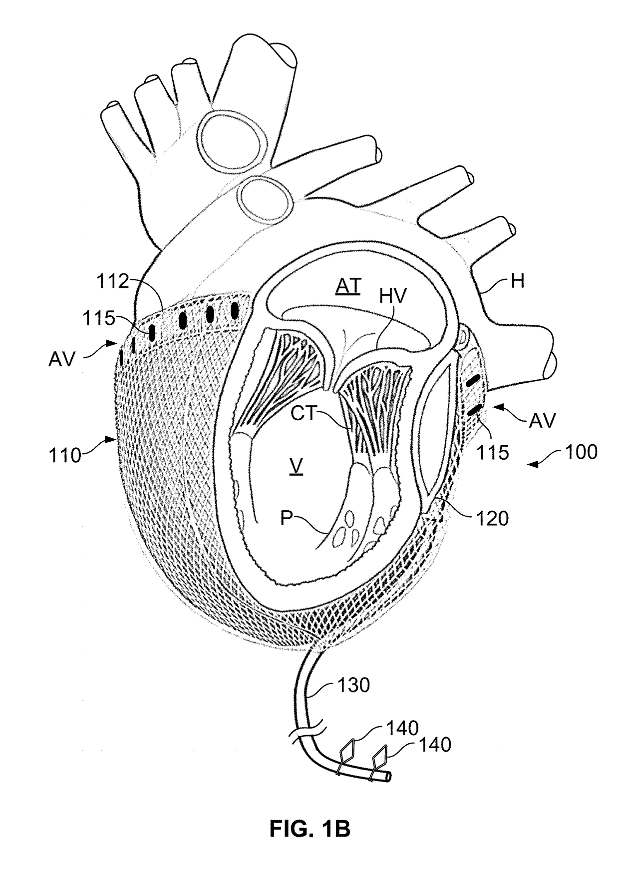 Cardiac treatment system and method