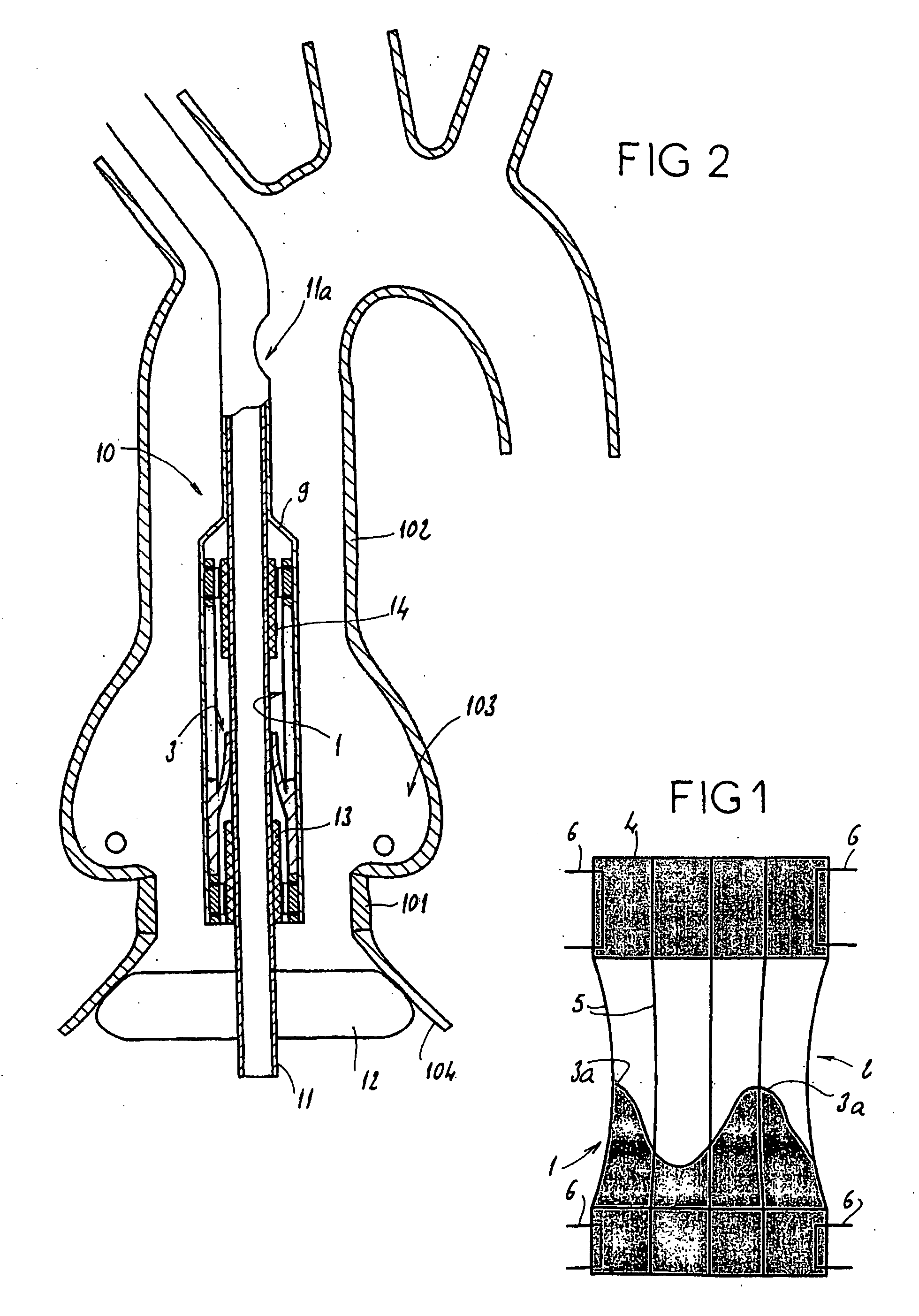 Assembly for setting a valve prosthesis in a corporeal duct