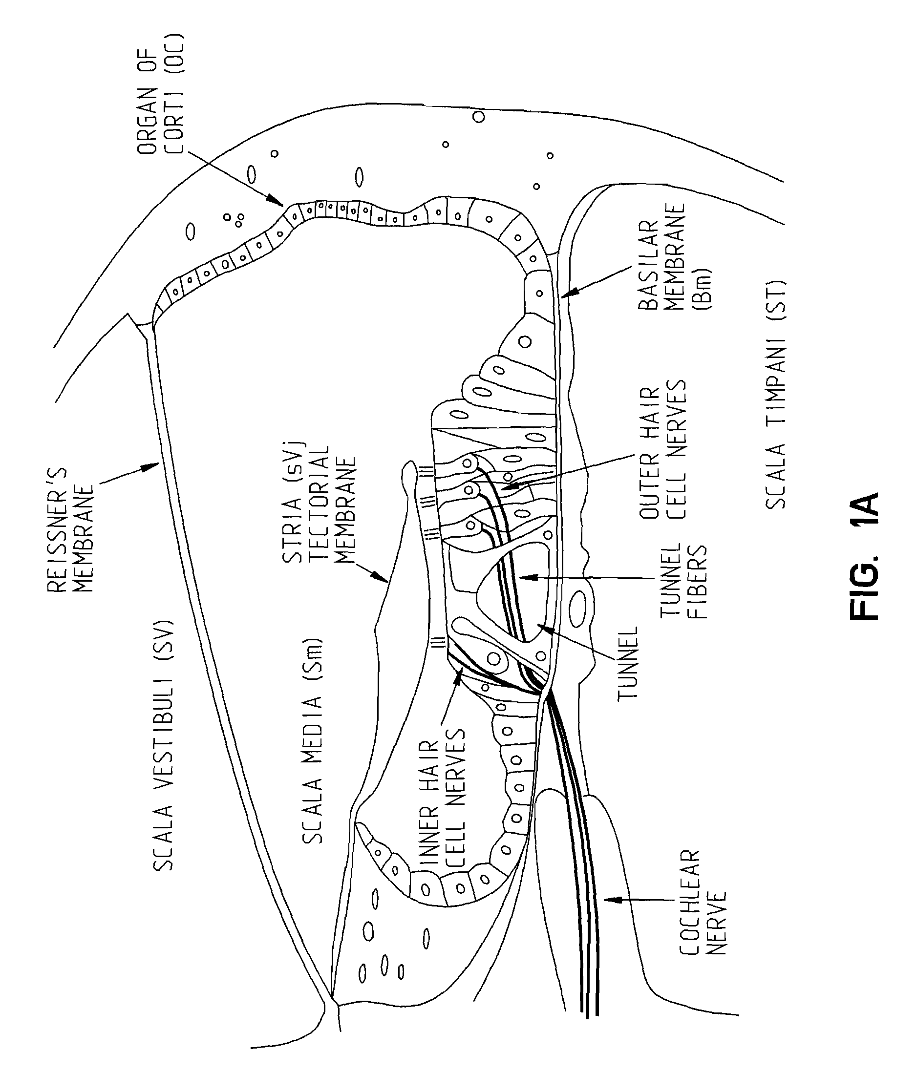 Intracochlear Nanotechnology and Perfusion Hearing Aid Device