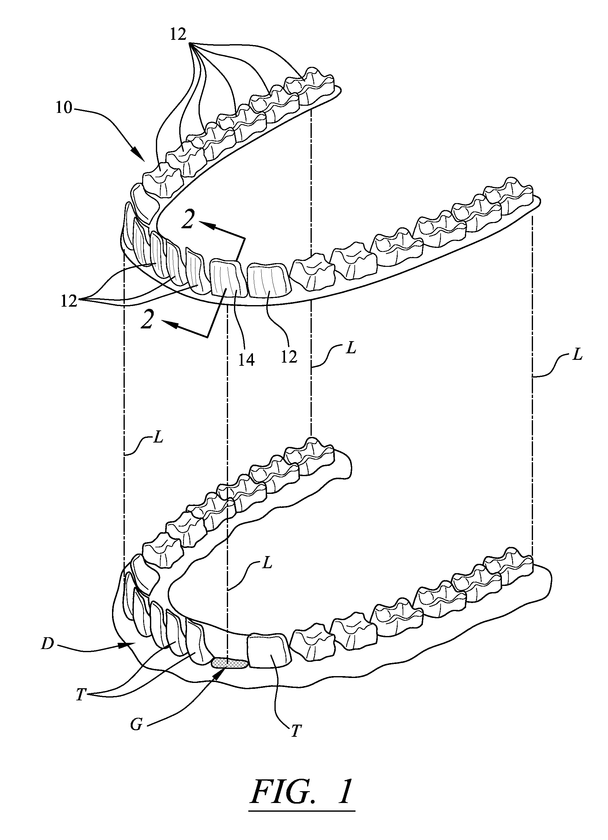 Enhancement to dental alignment device