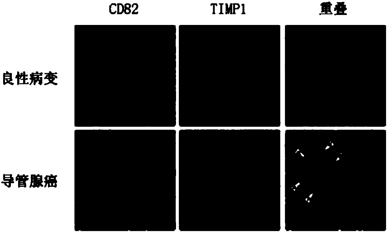 Antibody composition and application thereof for detecting immunohistochemical marker protein combination of pancreatic ductal adenocarcinoma